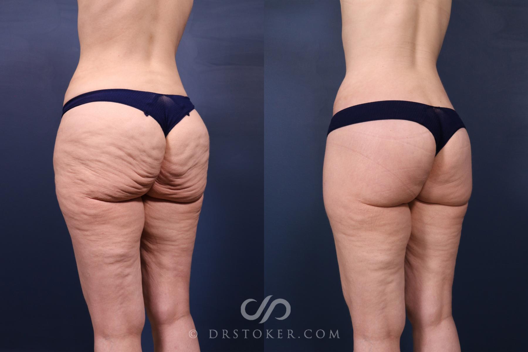 Before & After Bikini Body Lift ™ Case 2633 Left Oblique View in Los Angeles, CA