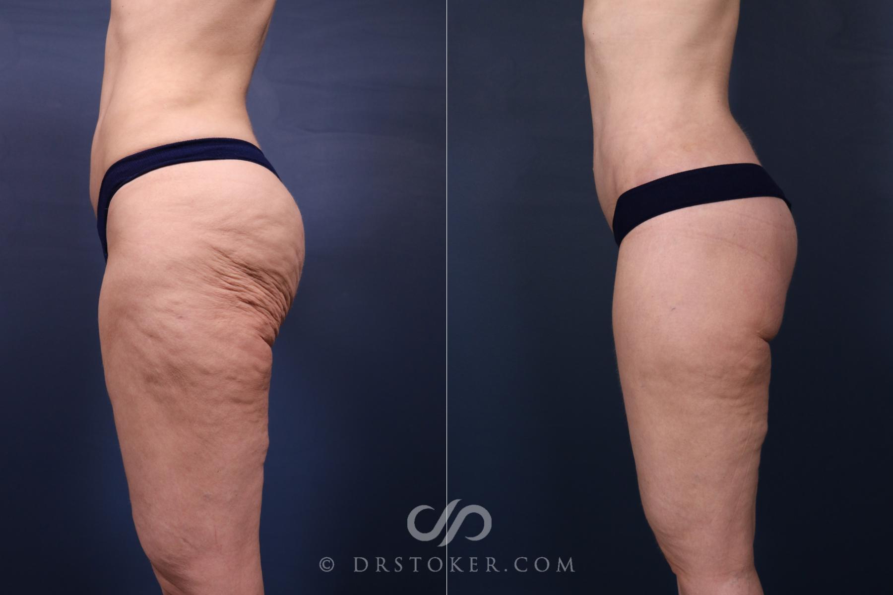 Before & After Bikini Body Lift ™ Case 2633 Left Side View in Los Angeles, CA