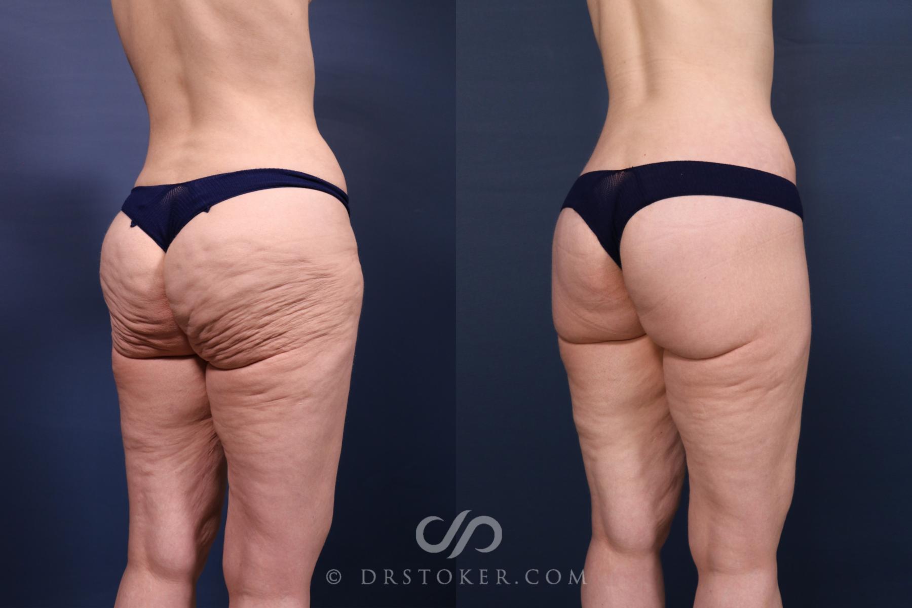 Before & After Bikini Body Lift ™ Case 2633 Right Oblique View in Los Angeles, CA