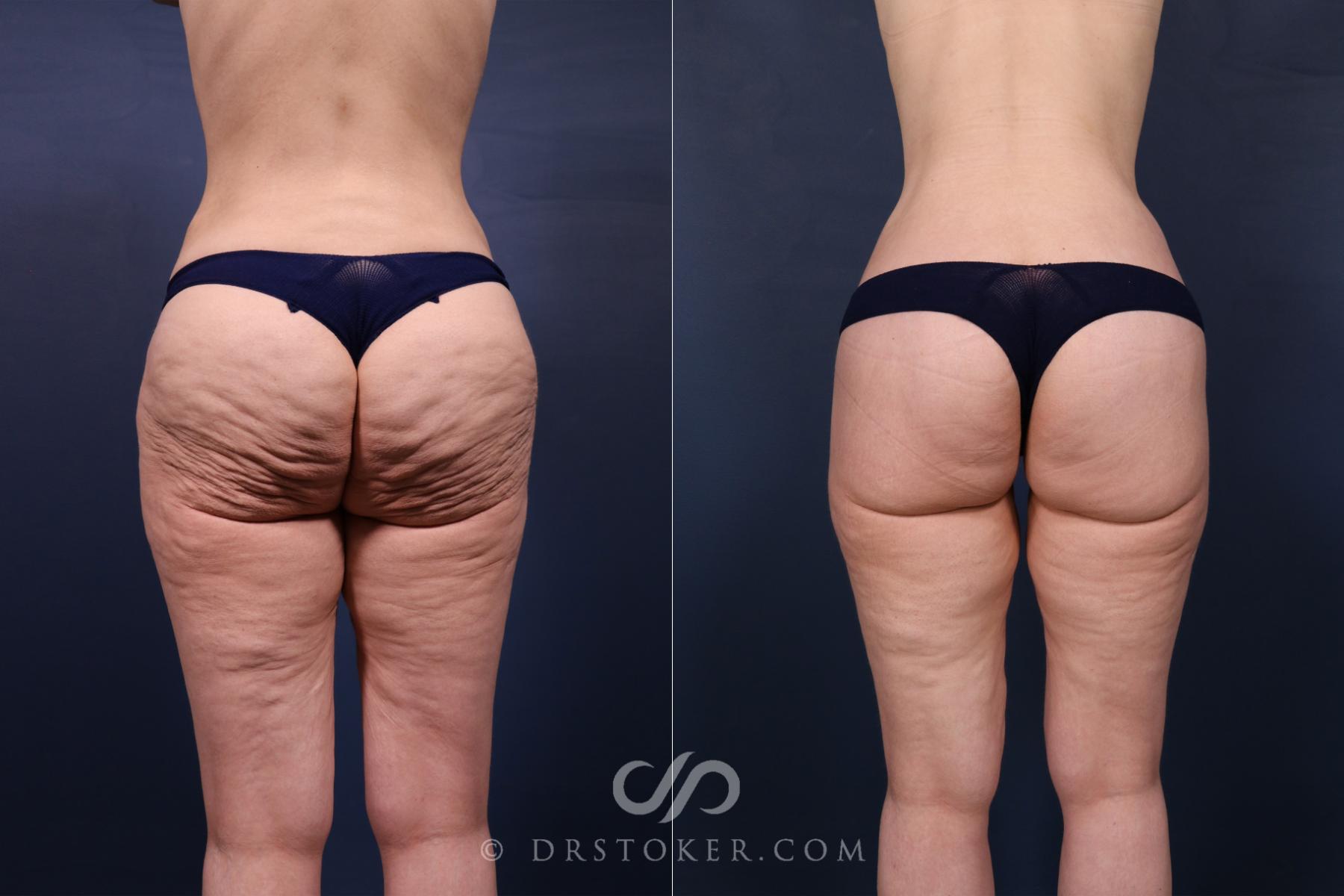Before & After Bikini Body Lift ™ Case 2634 Back View in Los Angeles, CA