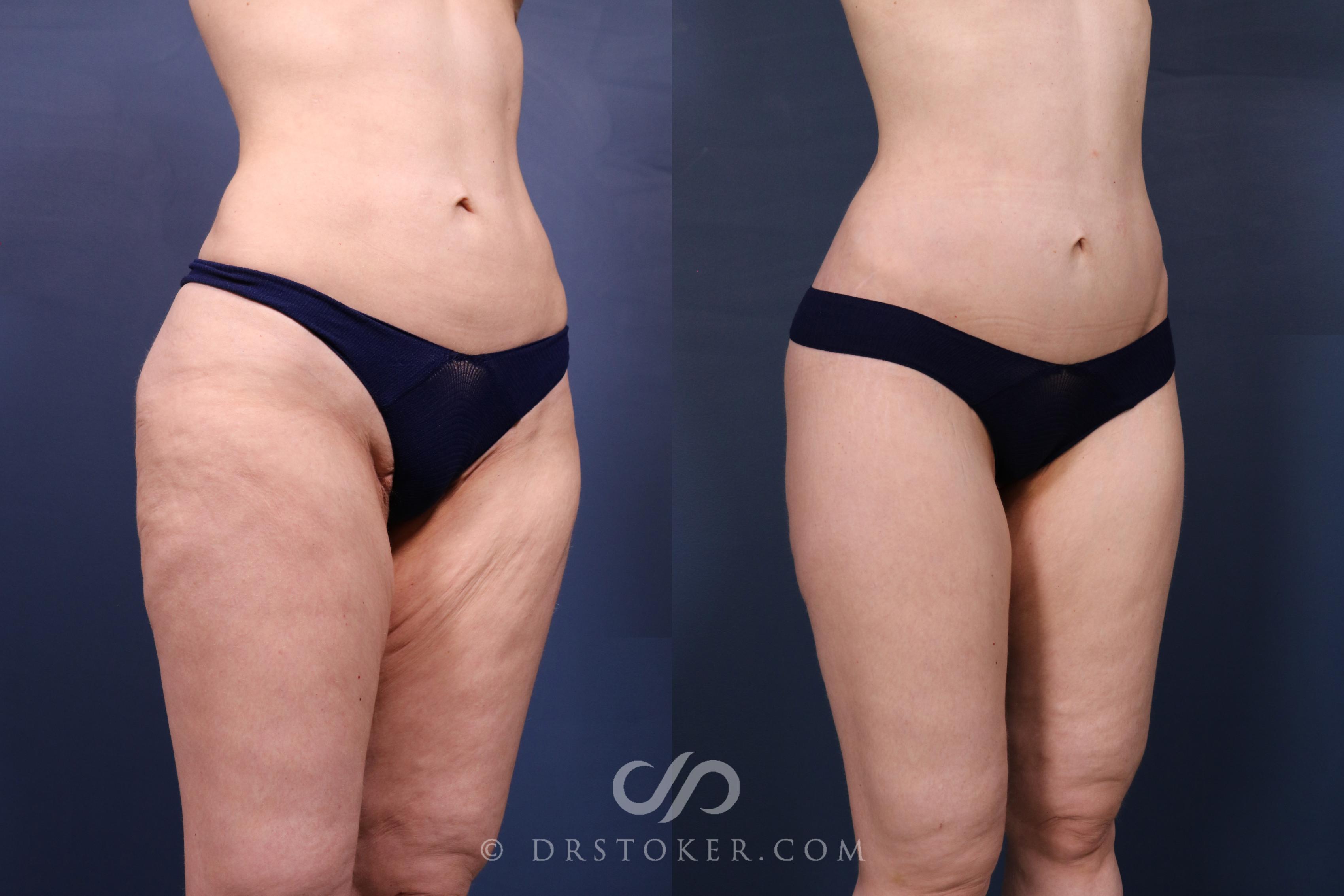 Before & After Bikini Body Lift ™ Case 2634 front right oblique View in Los Angeles, CA