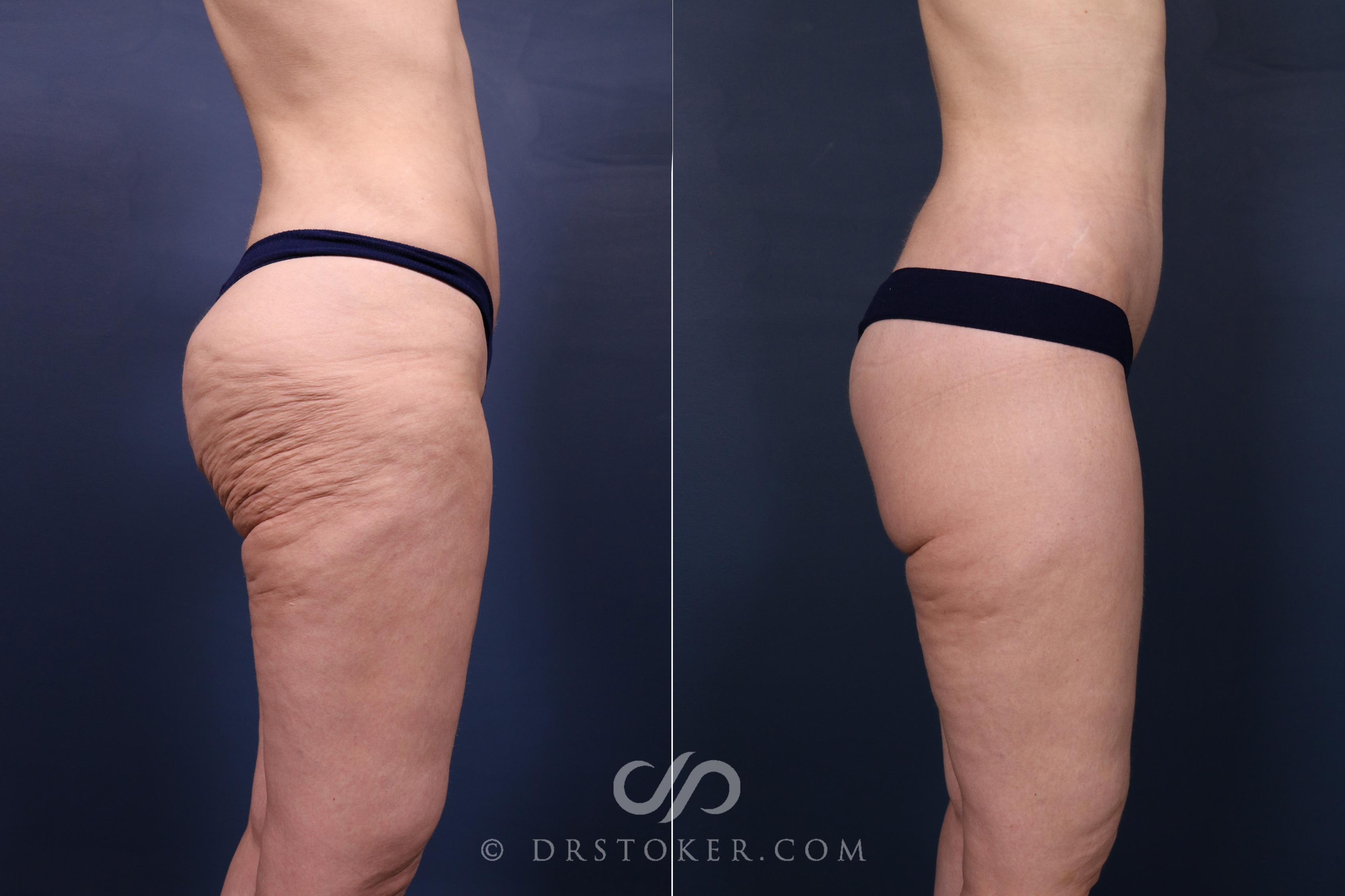 Before & After Bikini Body Lift ™ Case 2634 Right Side View in Los Angeles, CA