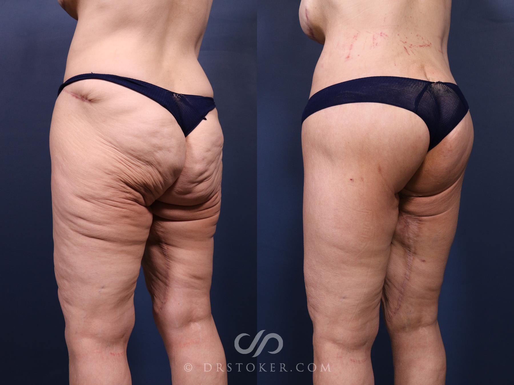 Before & After Bikini Body Lift ™ Case 2693 Left Oblique View in Los Angeles, CA