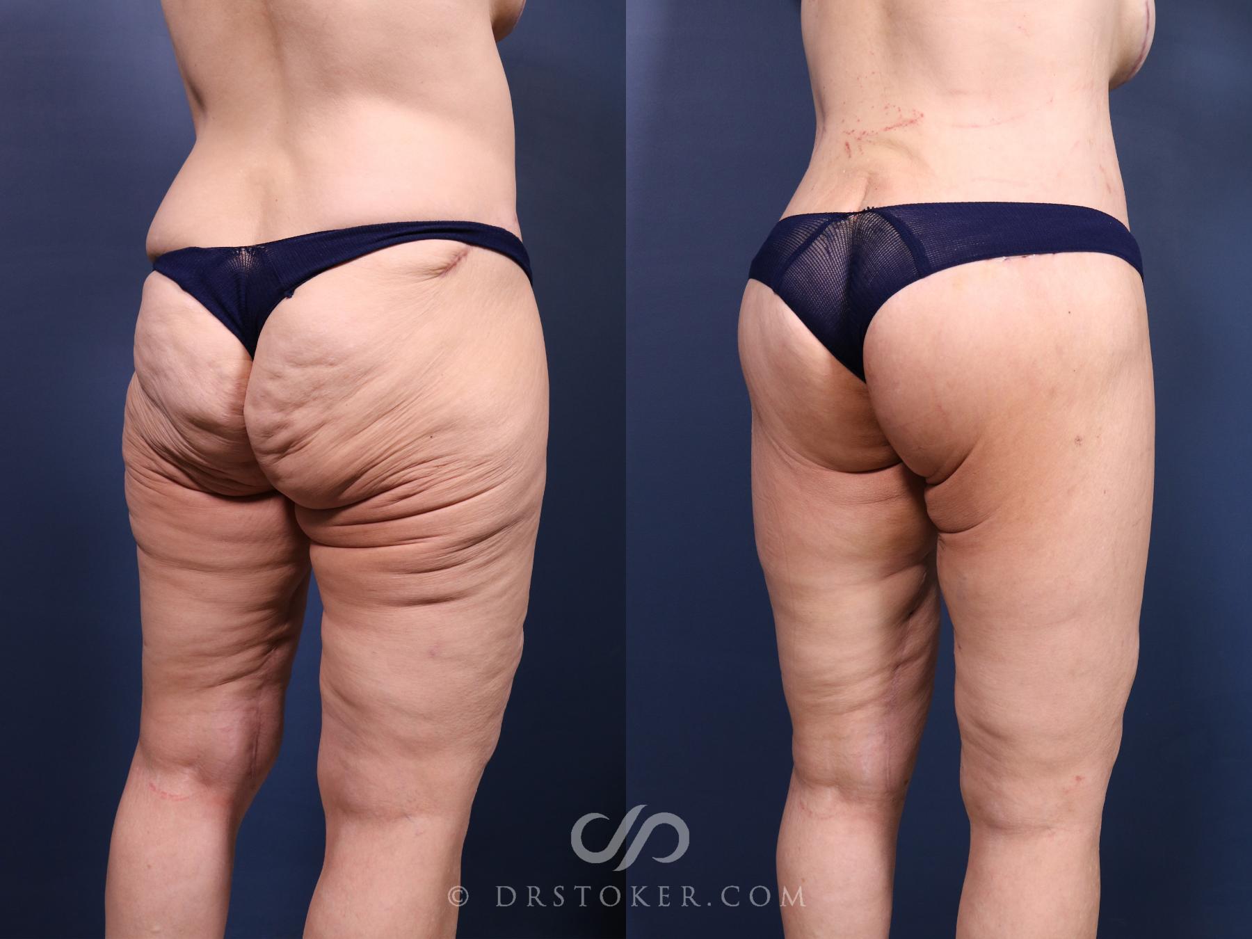 Before & After Bikini Body Lift ™ Case 2693 Right Oblique View in Los Angeles, CA