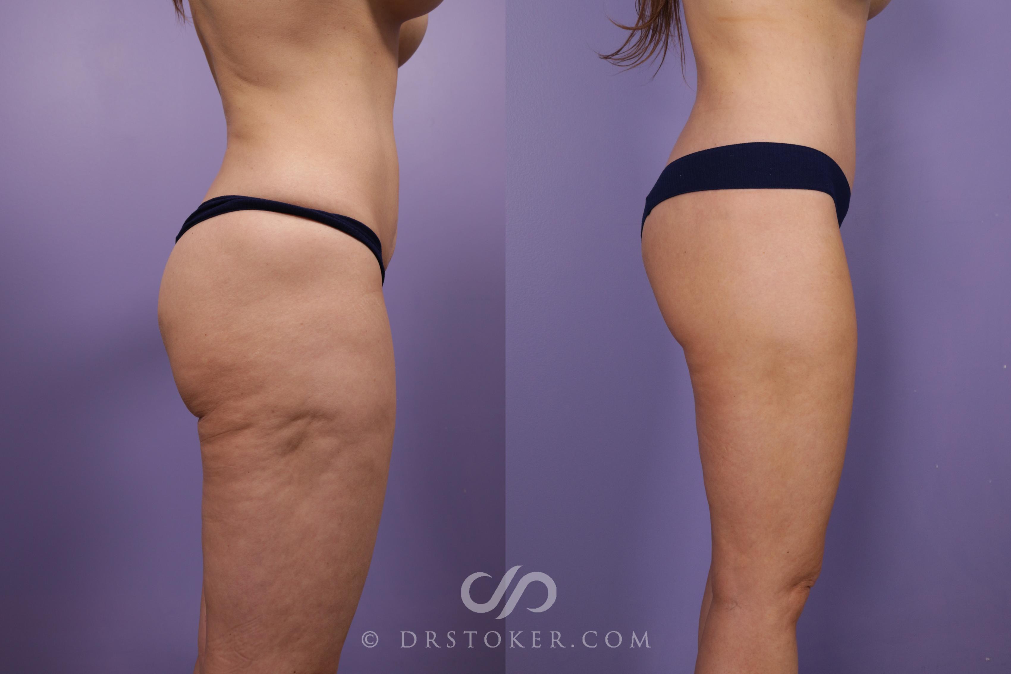 Before & After Bikini Body Lift ™ Case 2500 Right Side View in Los Angeles, CA
