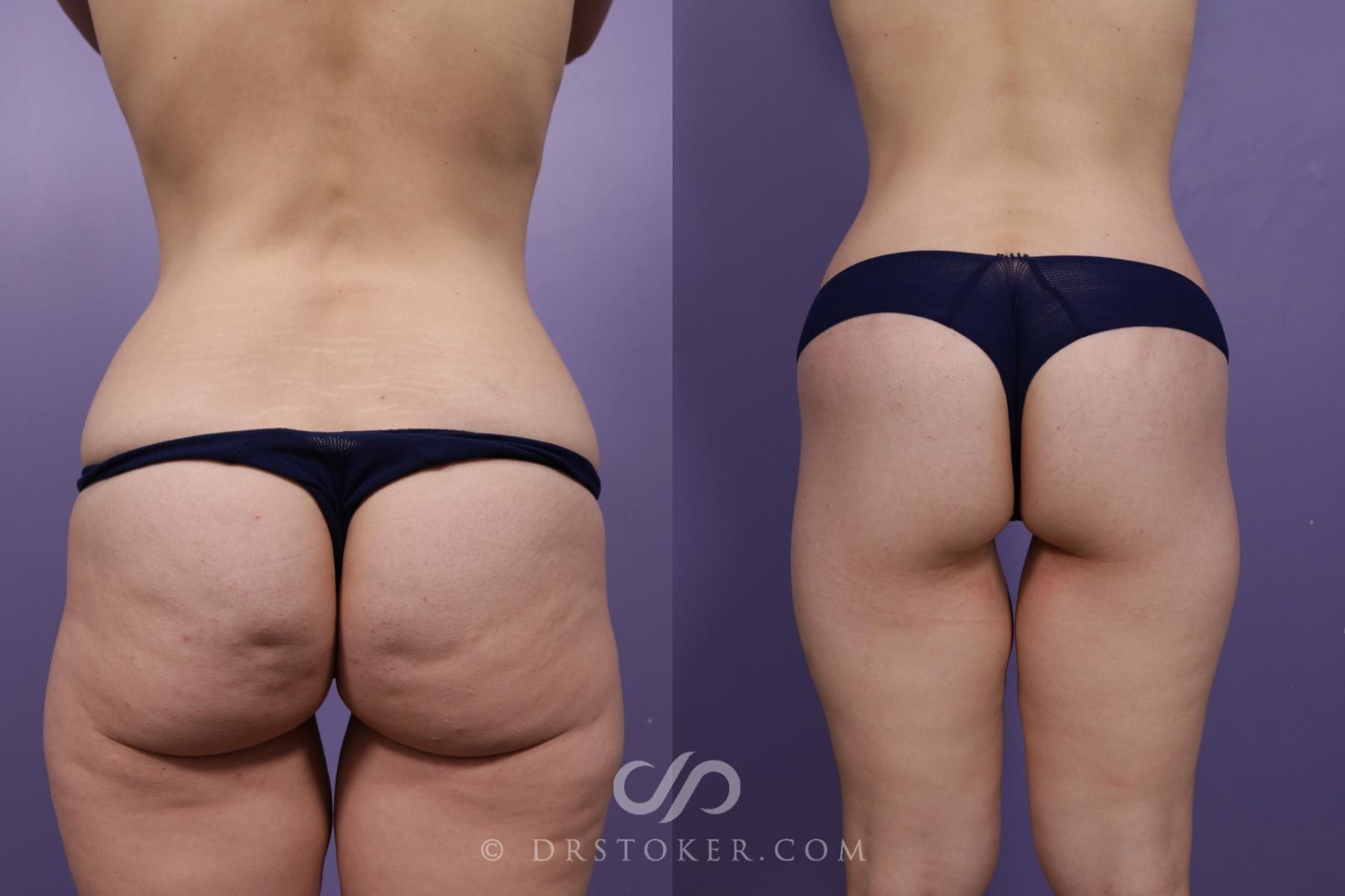 Before & After Bikini Body Lift ™ Case 2503 Back View in Los Angeles, CA