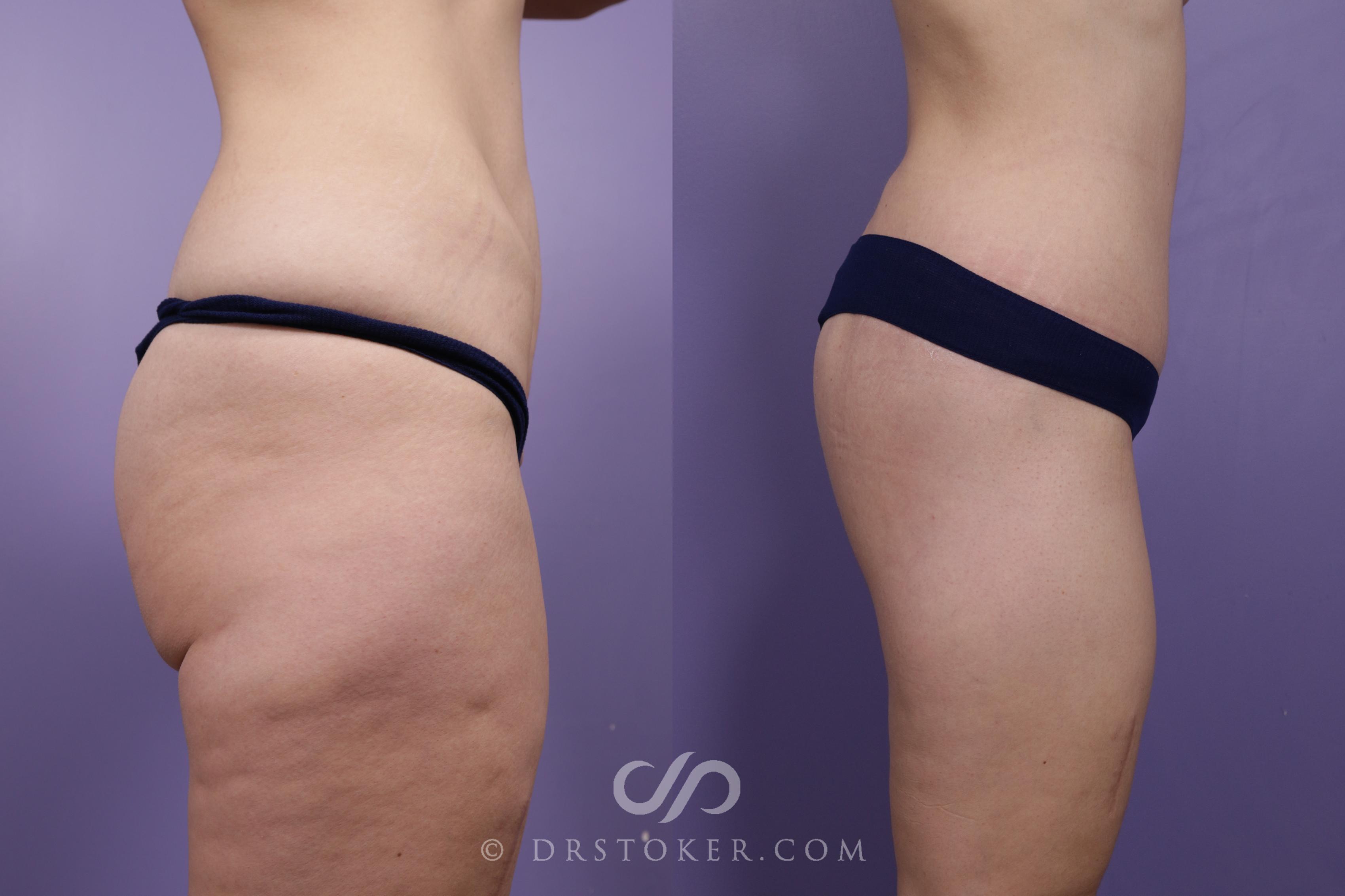 Before & After Bikini Body Lift ™ Case 2503 Right Side View in Los Angeles, CA