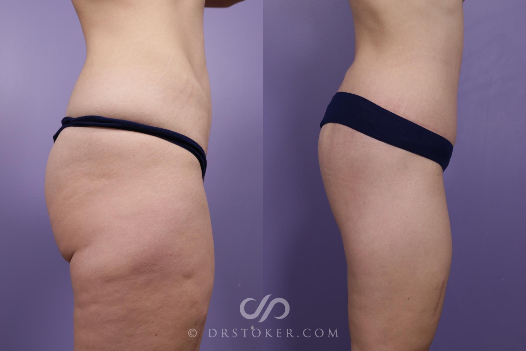 Before & After Bikini Body Lift ™ Case 2503 Right Side View in Los Angeles, CA