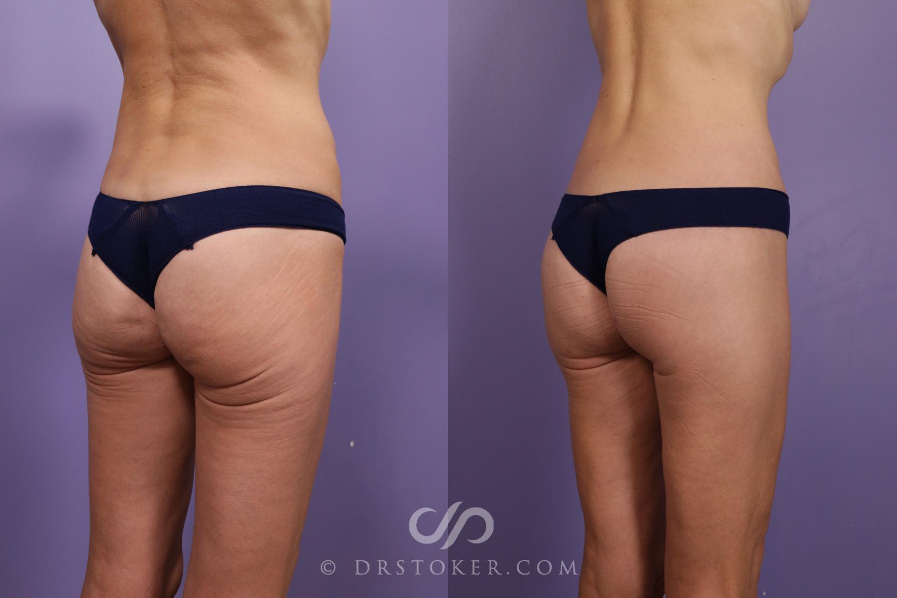 Before & After Bikini Body Lift ™ Case 2505 Right Oblique View in Los Angeles, CA