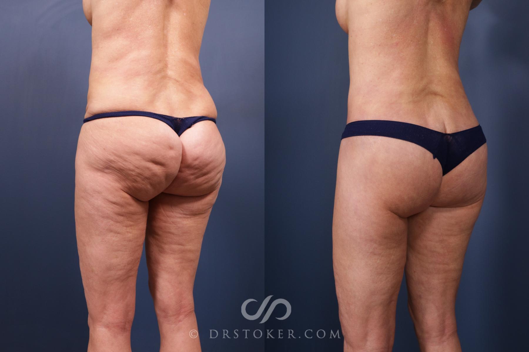 Before & After Bikini Body Lift ™ Case 2506 Left Oblique View in Los Angeles, CA