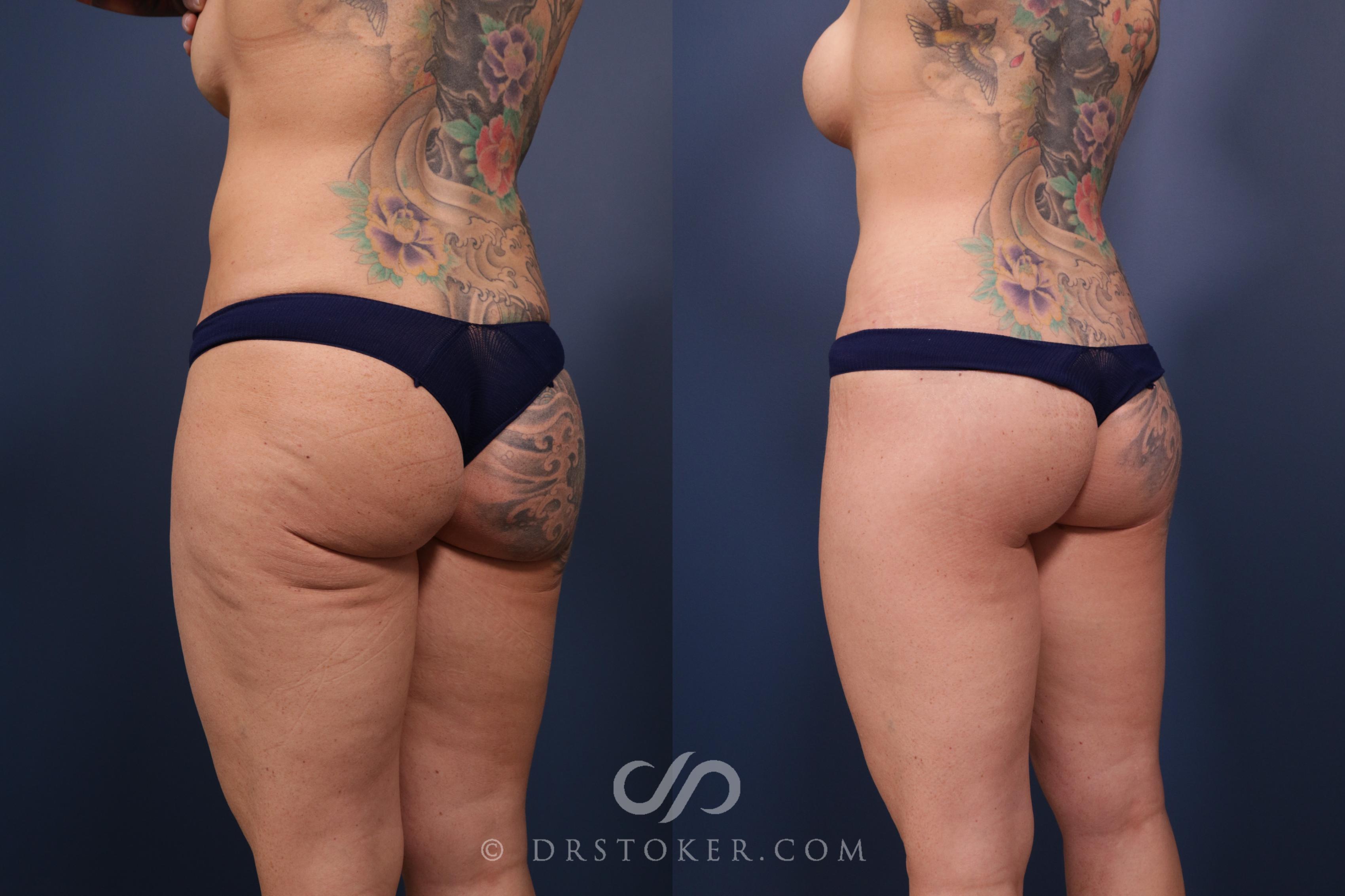 Before & After Bikini Body Lift ™ Case 2507 Left Oblique View in Los Angeles, CA