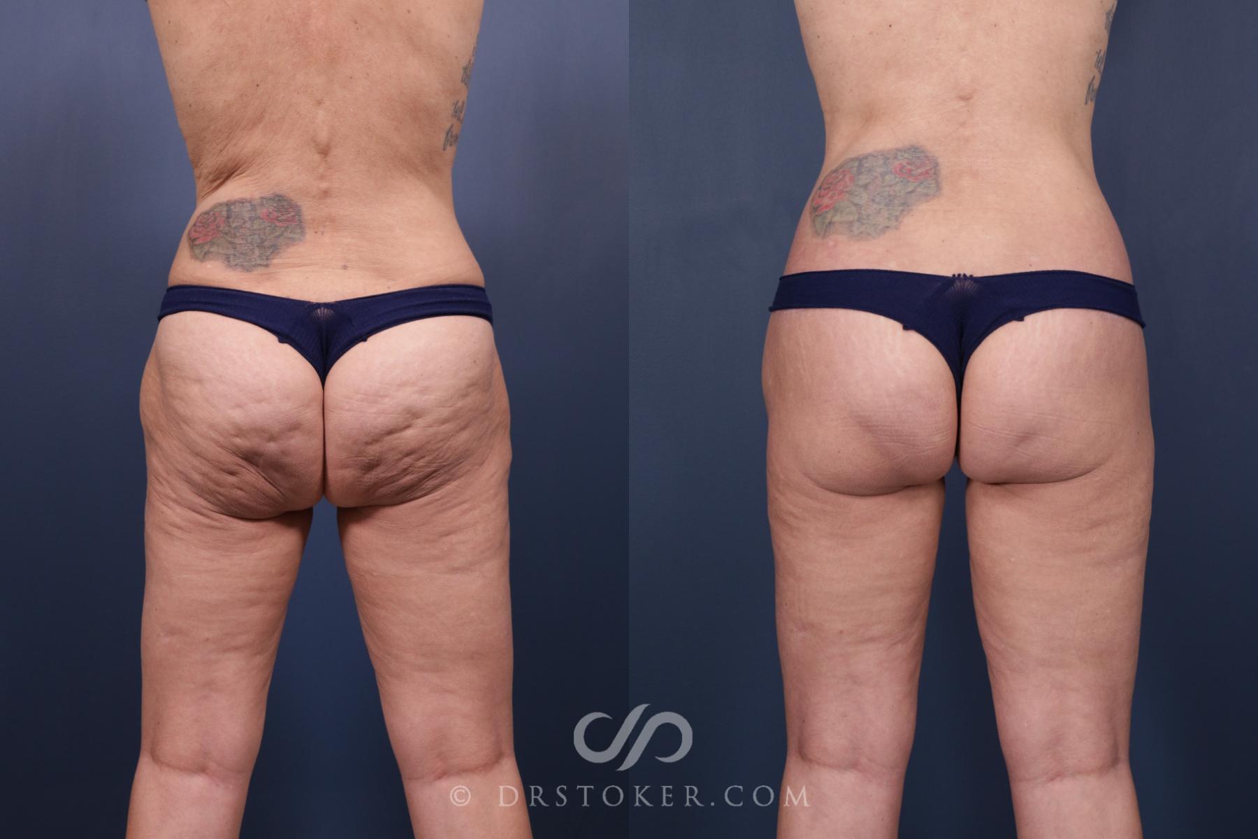 Before & After Bikini Body Lift ™ Case 2508 Left Side View in Los Angeles, CA