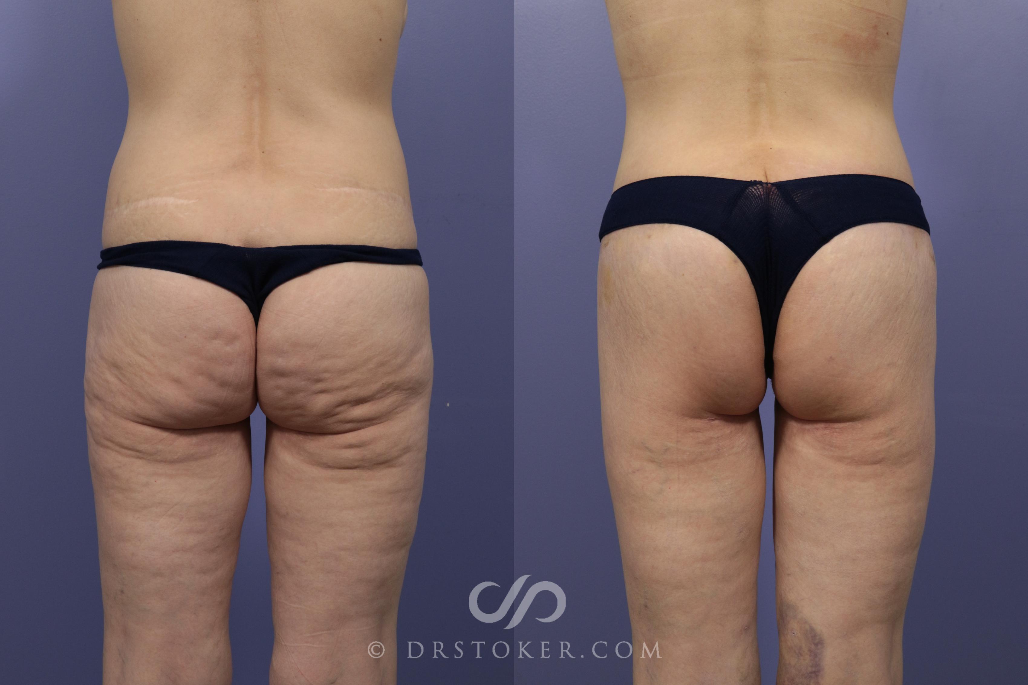 Before & After Bikini Body Lift ™ Case 2509 Back View in Los Angeles, CA
