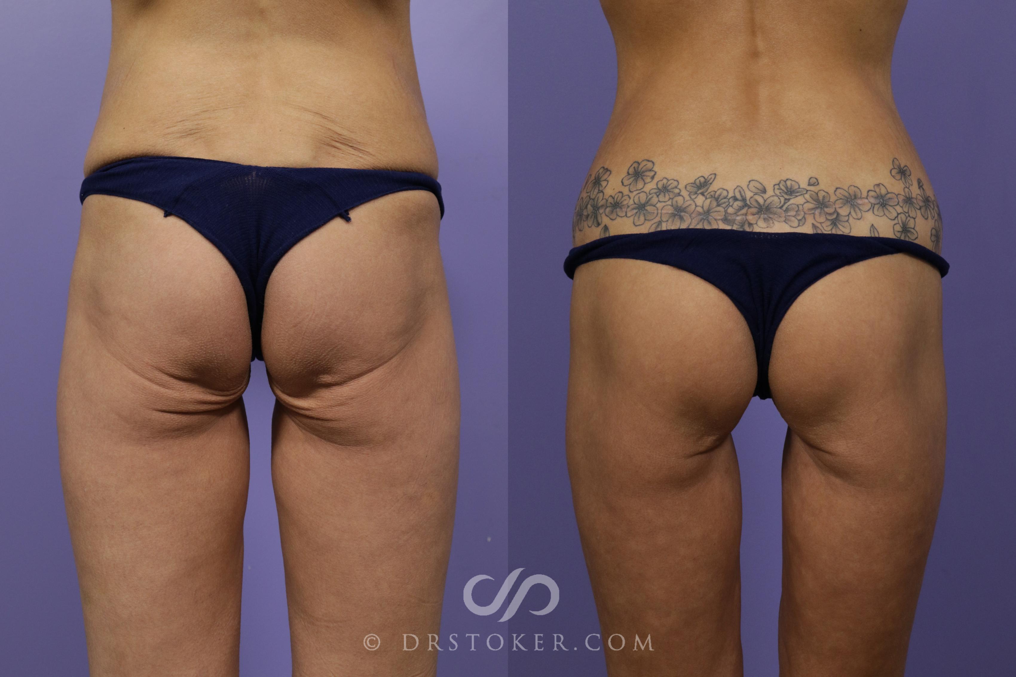 Before & After Bikini Body Lift ™ Case 2510 Back View in Los Angeles, CA