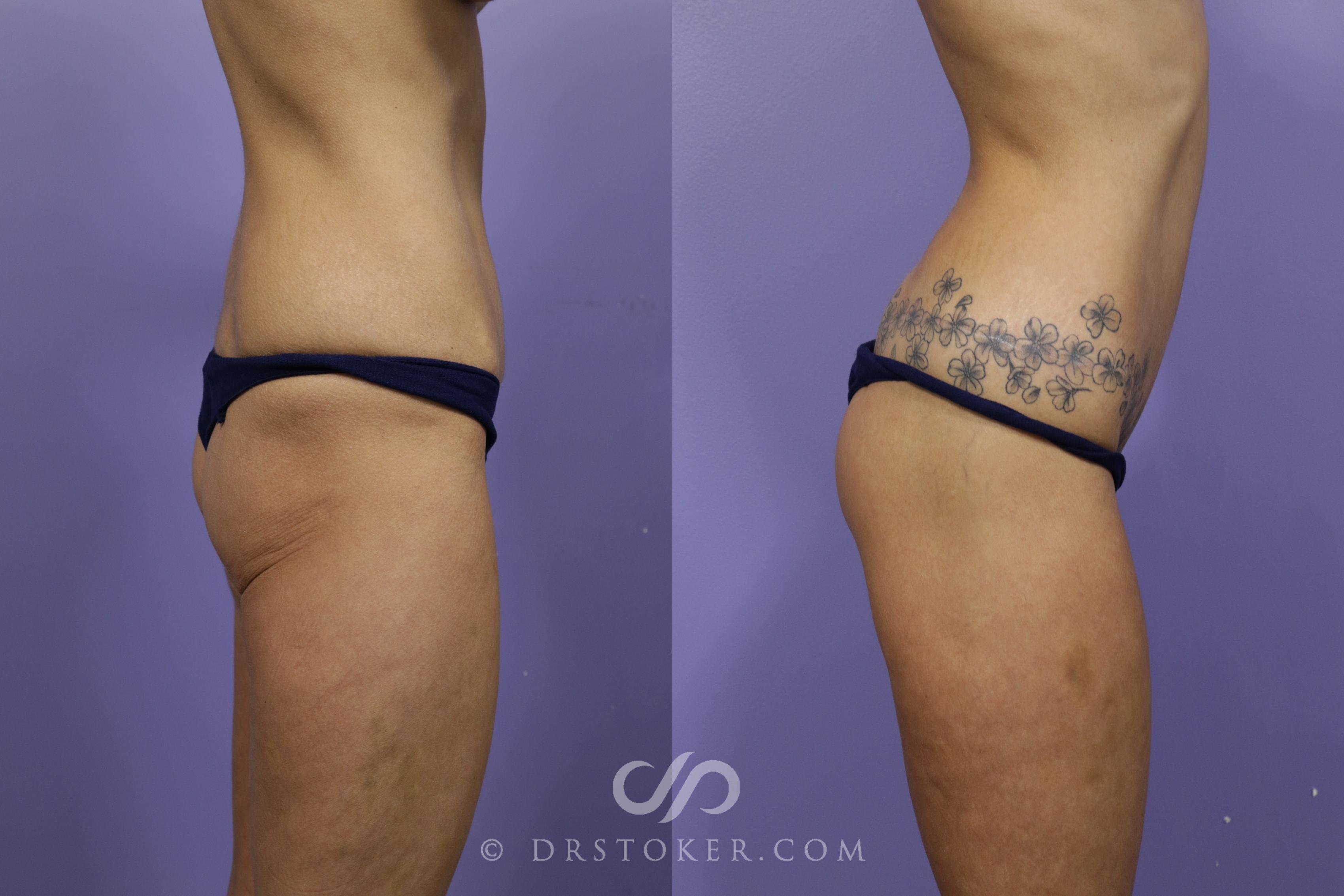 Before & After Bikini Body Lift ™ Case 2510 Right Side View in Los Angeles, CA