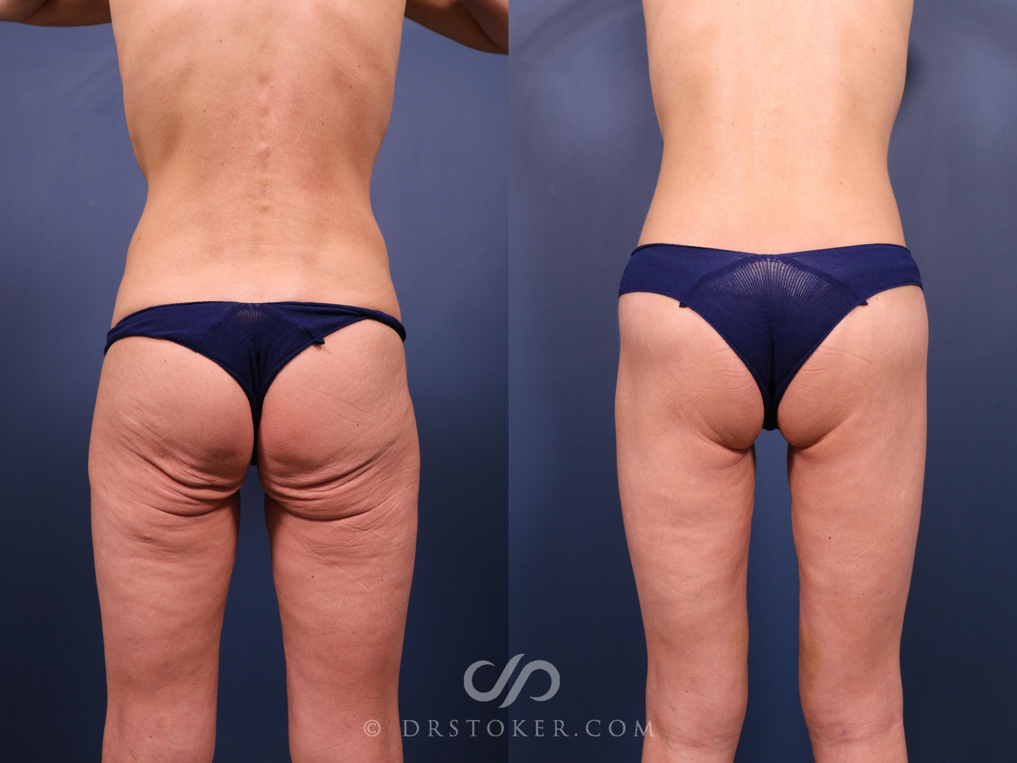 Before & After Bikini Body Lift ™ Case 2512 Back View in Los Angeles, CA