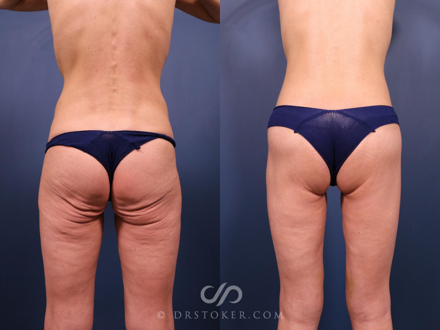 Before & After Bikini Body Lift ™ Case 2512 Back View in Los Angeles, CA