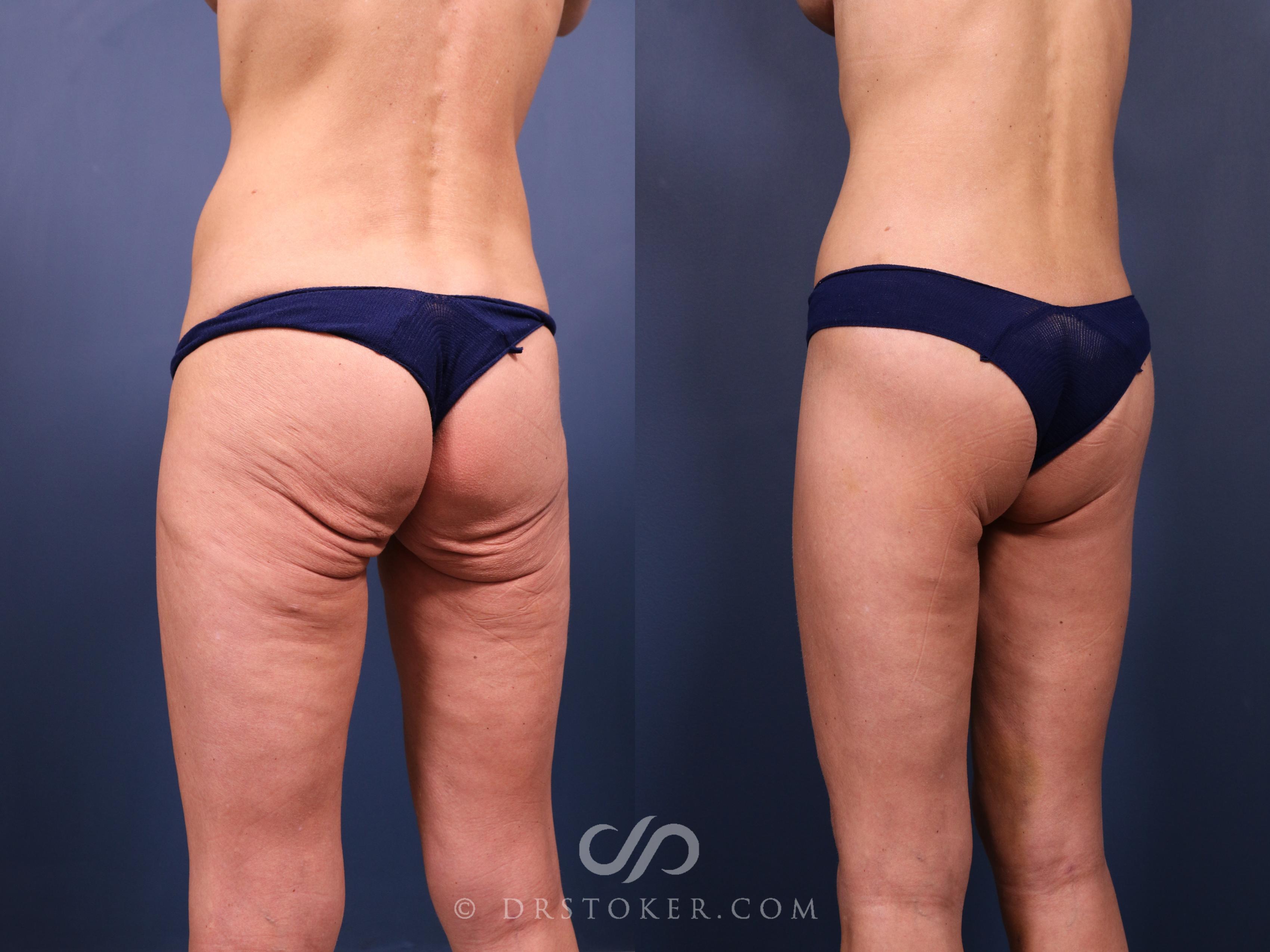 Before & After Bikini Body Lift ™ Case 2512 Left Oblique View in Los Angeles, CA