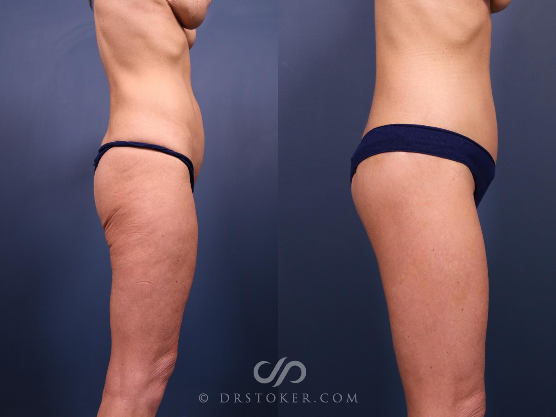 Before & After Bikini Body Lift ™ Case 2512 Right Side View in Los Angeles, CA
