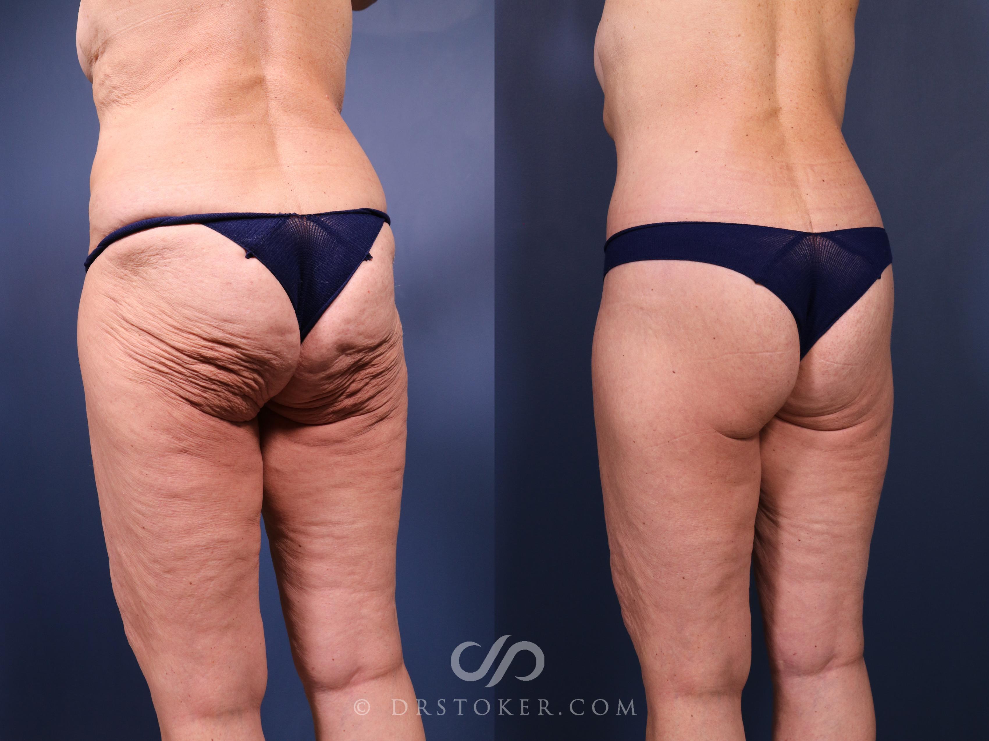 Before & After Bikini Body Lift ™ Case 2514 Left Oblique View in Los Angeles, CA