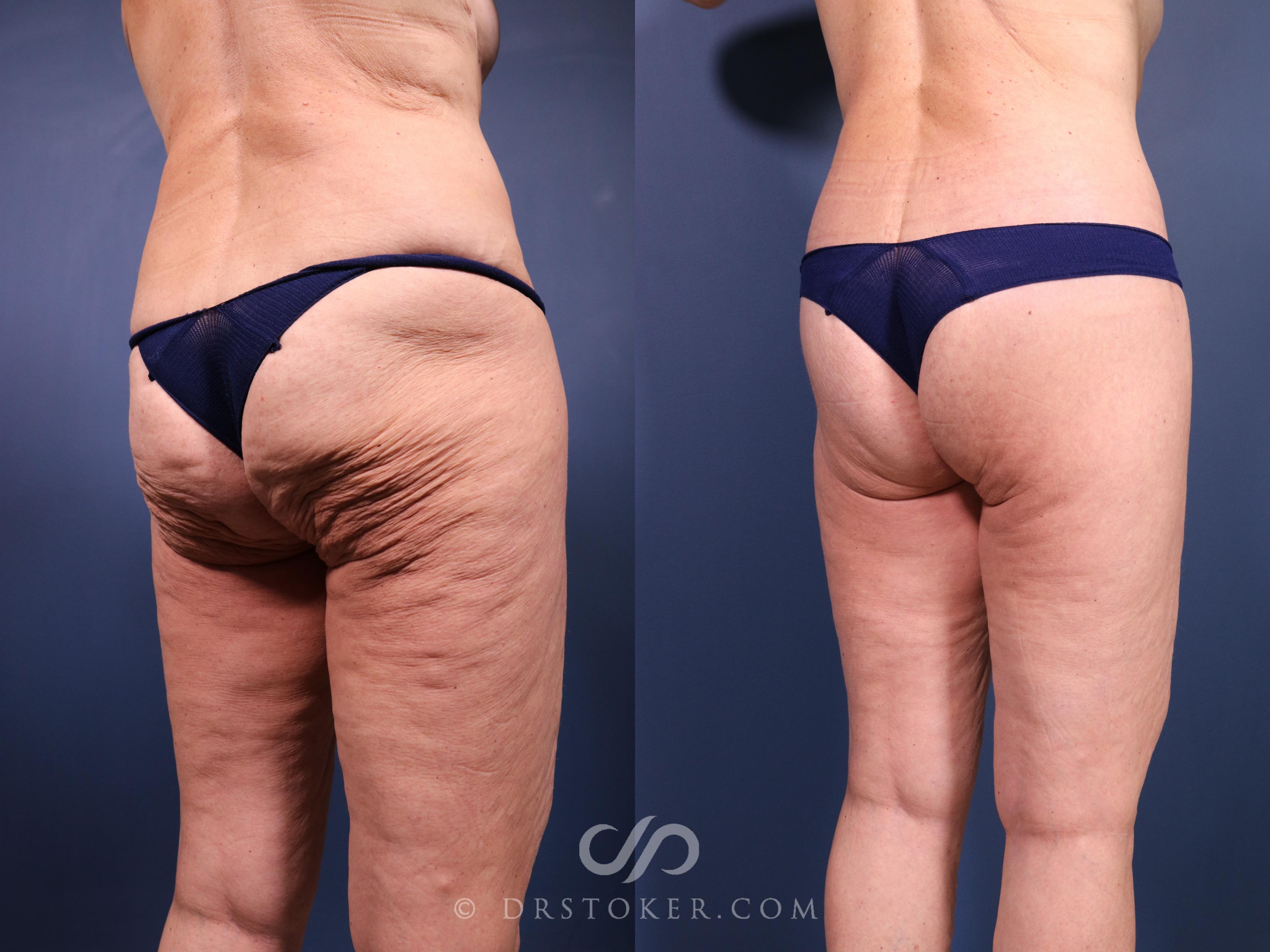Before & After Bikini Body Lift ™ Case 2514 Right Oblique View in Los Angeles, CA