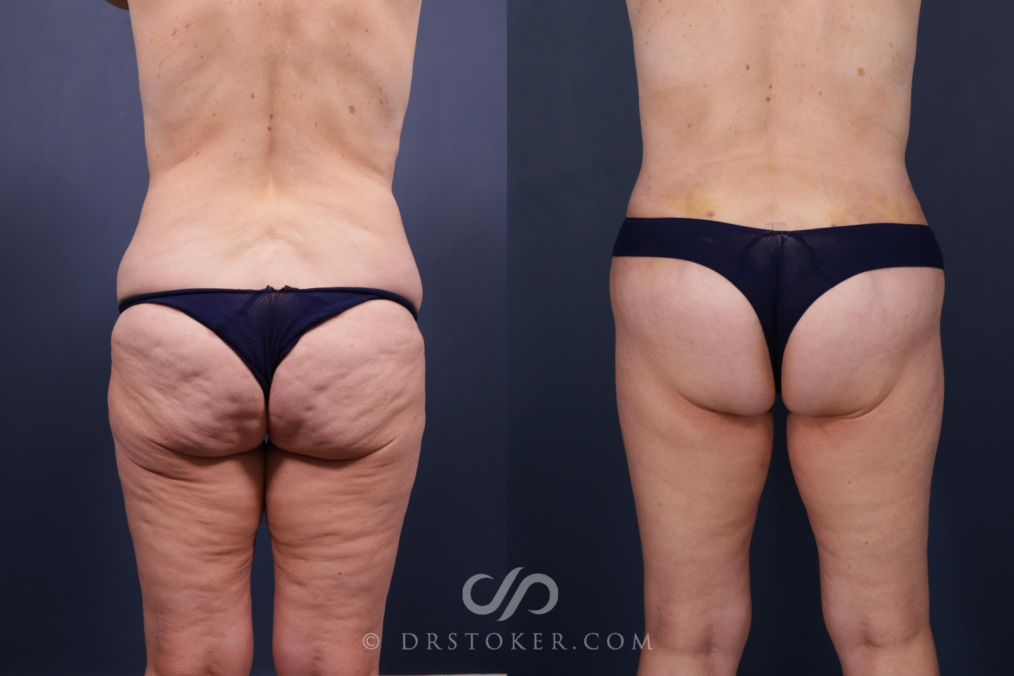 Before & After Bikini Body Lift ™ Case 2515 Back View in Los Angeles, CA