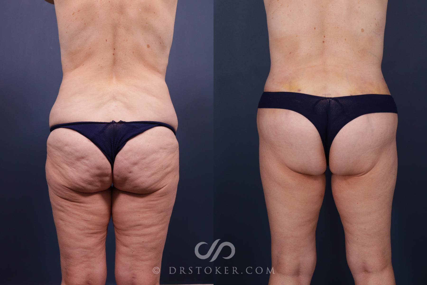Before & After Bikini Body Lift ™ Case 2515 Back View in Los Angeles, CA