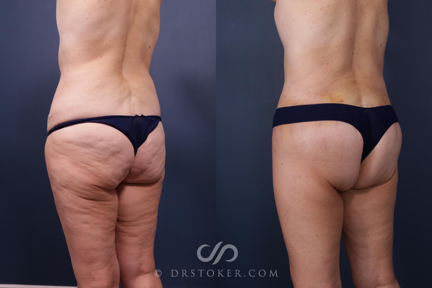 Before & After Bikini Body Lift ™ Case 2515 Left Oblique View in Los Angeles, CA