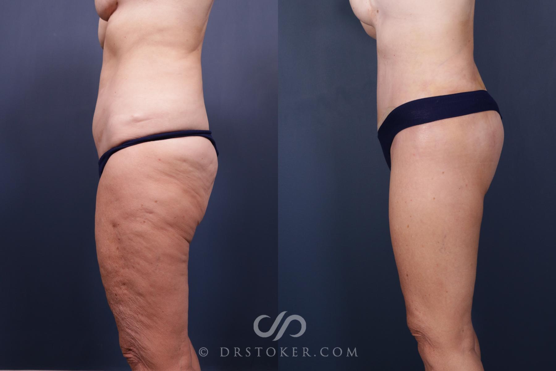 Before & After Bikini Body Lift ™ Case 2515 Left Side View in Los Angeles, CA
