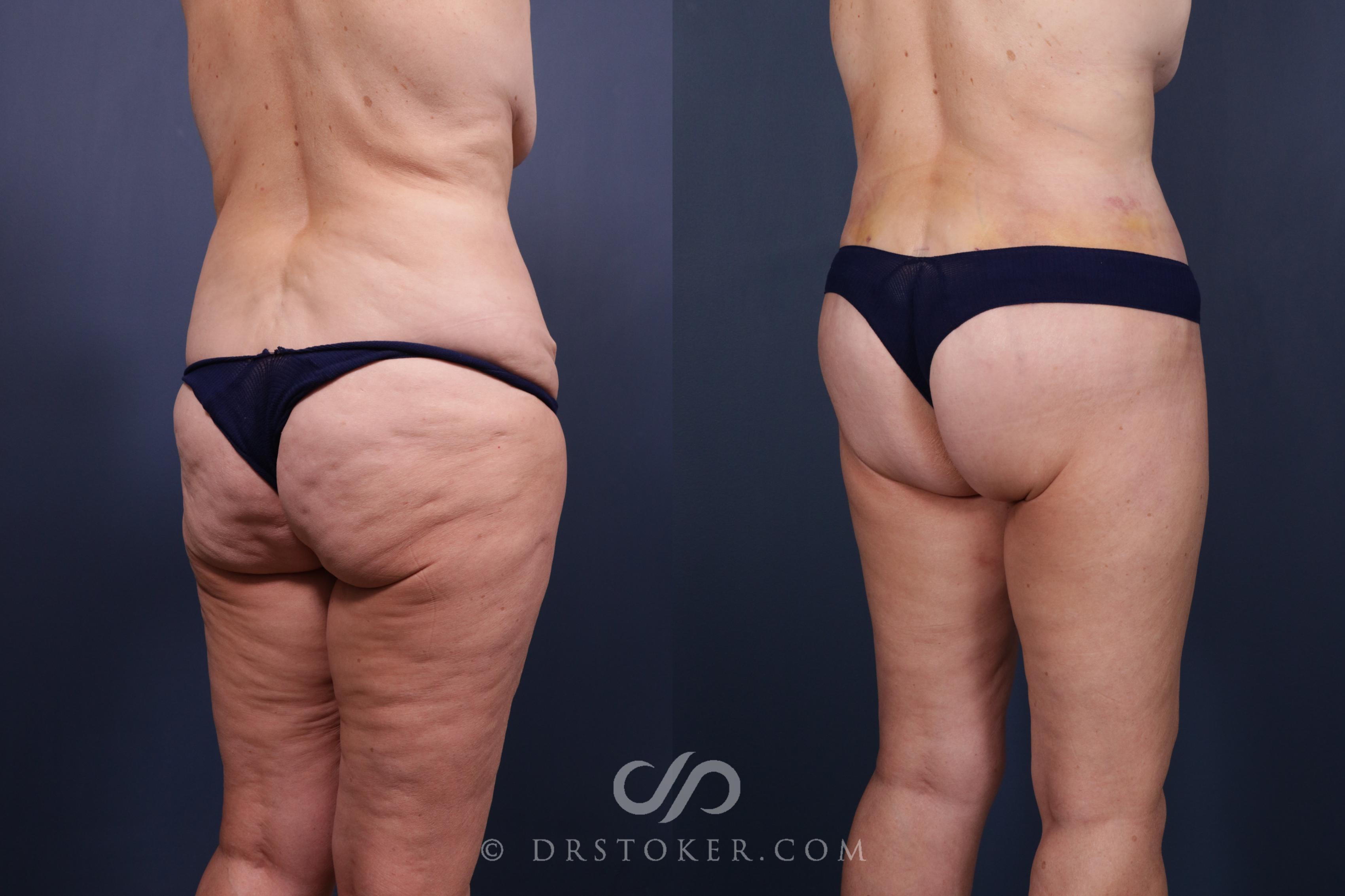 Before & After Bikini Body Lift ™ Case 2515 Right Oblique View in Los Angeles, CA
