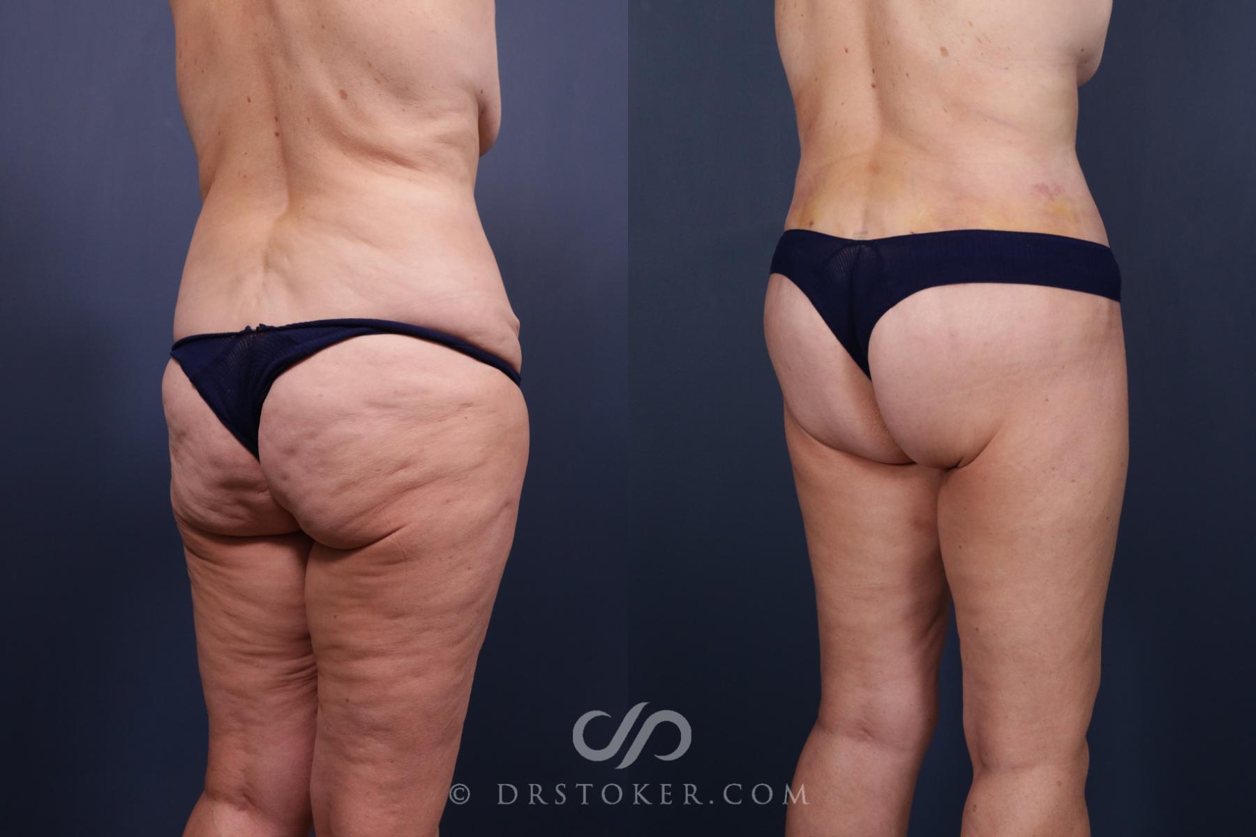 Before & After Bikini Body Lift ™ Case 2515 Right Oblique View in Los Angeles, CA