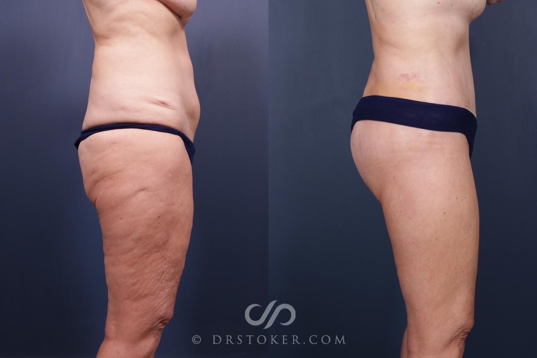 Before & After Bikini Body Lift ™ Case 2515 Right Side View in Los Angeles, CA