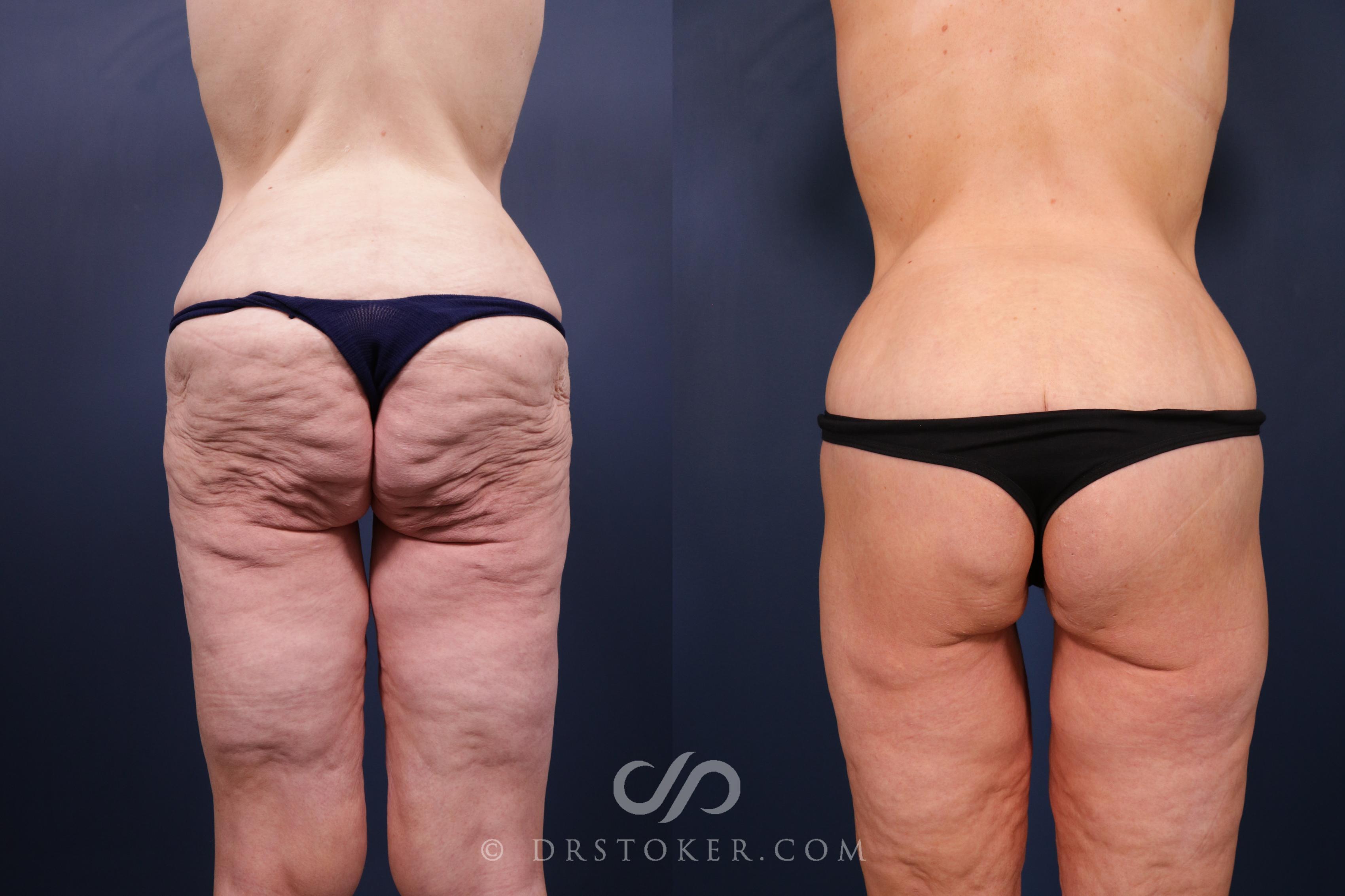 Before & After Bikini Body Lift ™ Case 2516 Back View in Los Angeles, CA