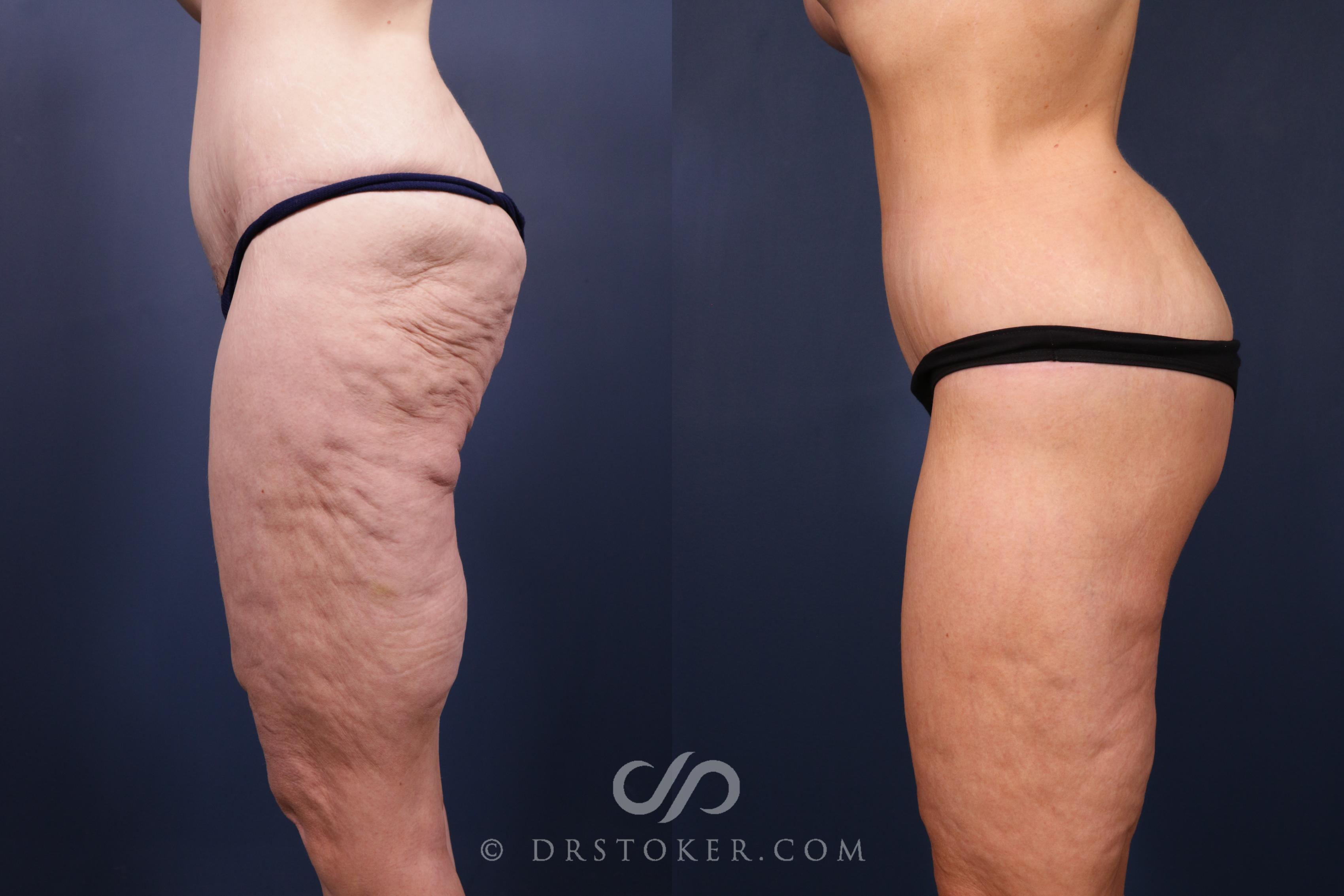 Before & After Bikini Body Lift ™ Case 2516 Left Side View in Los Angeles, CA