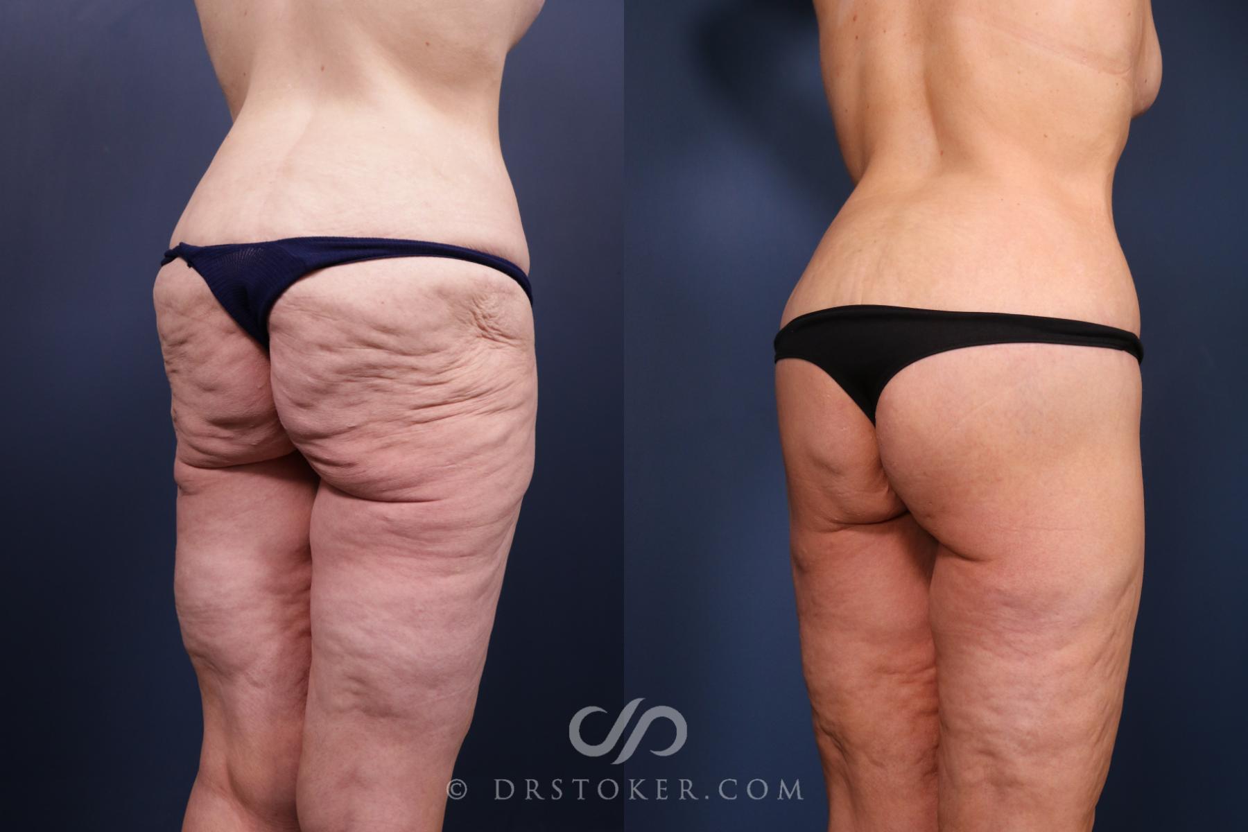Before & After Bikini Body Lift ™ Case 2516 Right Oblique View in Los Angeles, CA