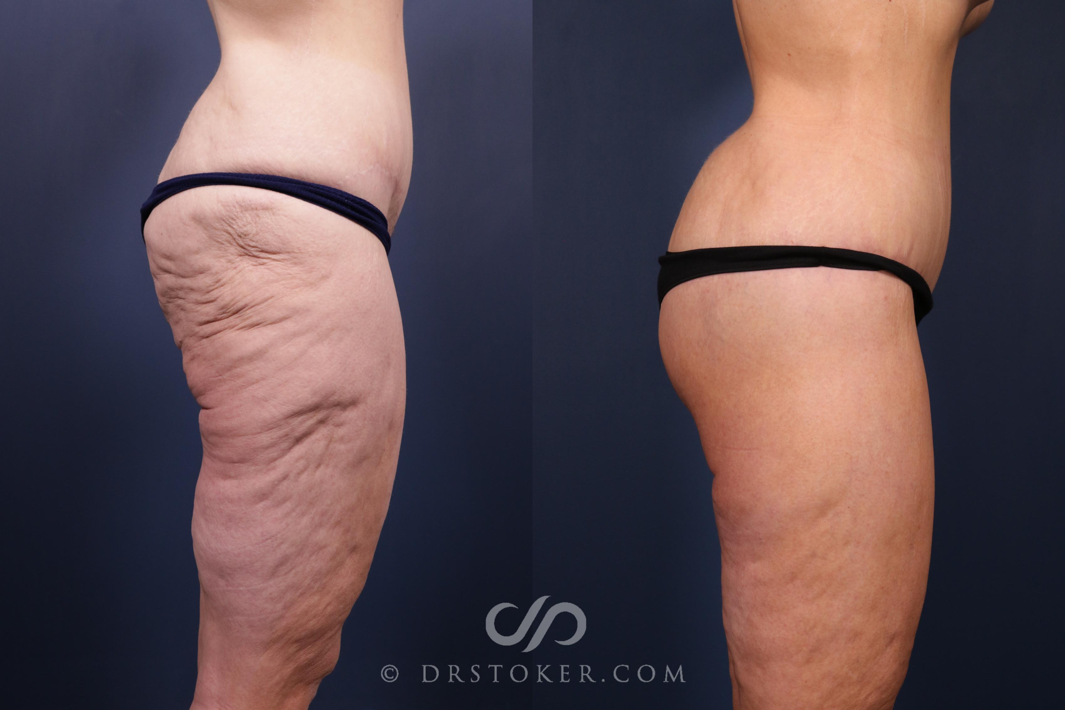 Before & After Bikini Body Lift ™ Case 2516 Right Side View in Los Angeles, CA