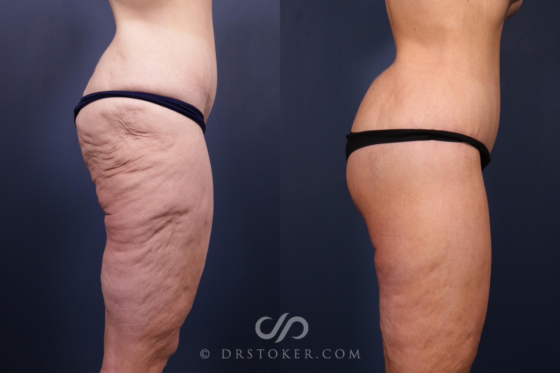 Before & After Bikini Body Lift ™ Case 2516 Right Side View in Los Angeles, CA