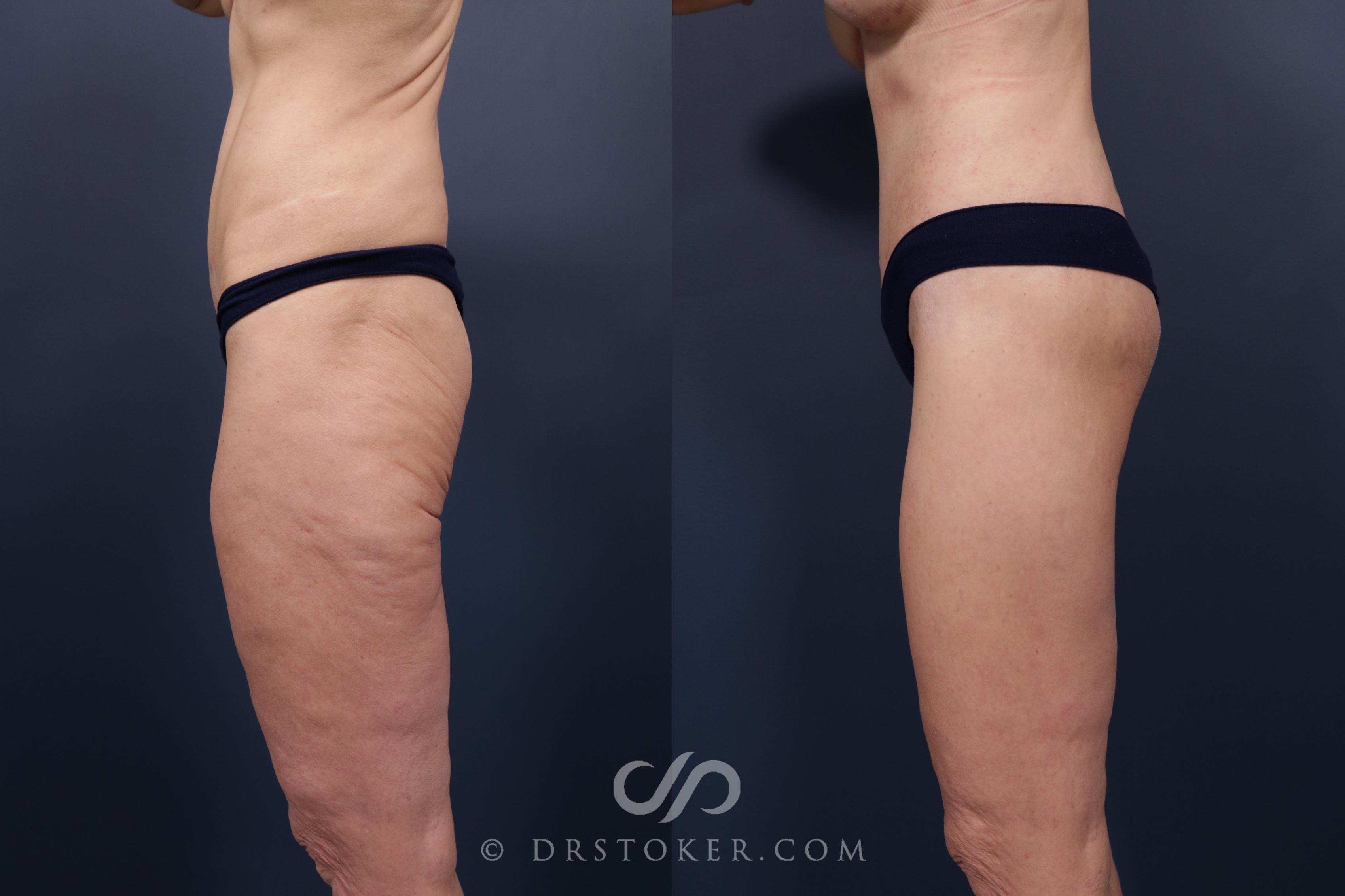 Before & After Bikini Body Lift ™ Case 2518 Left Side View in Los Angeles, CA