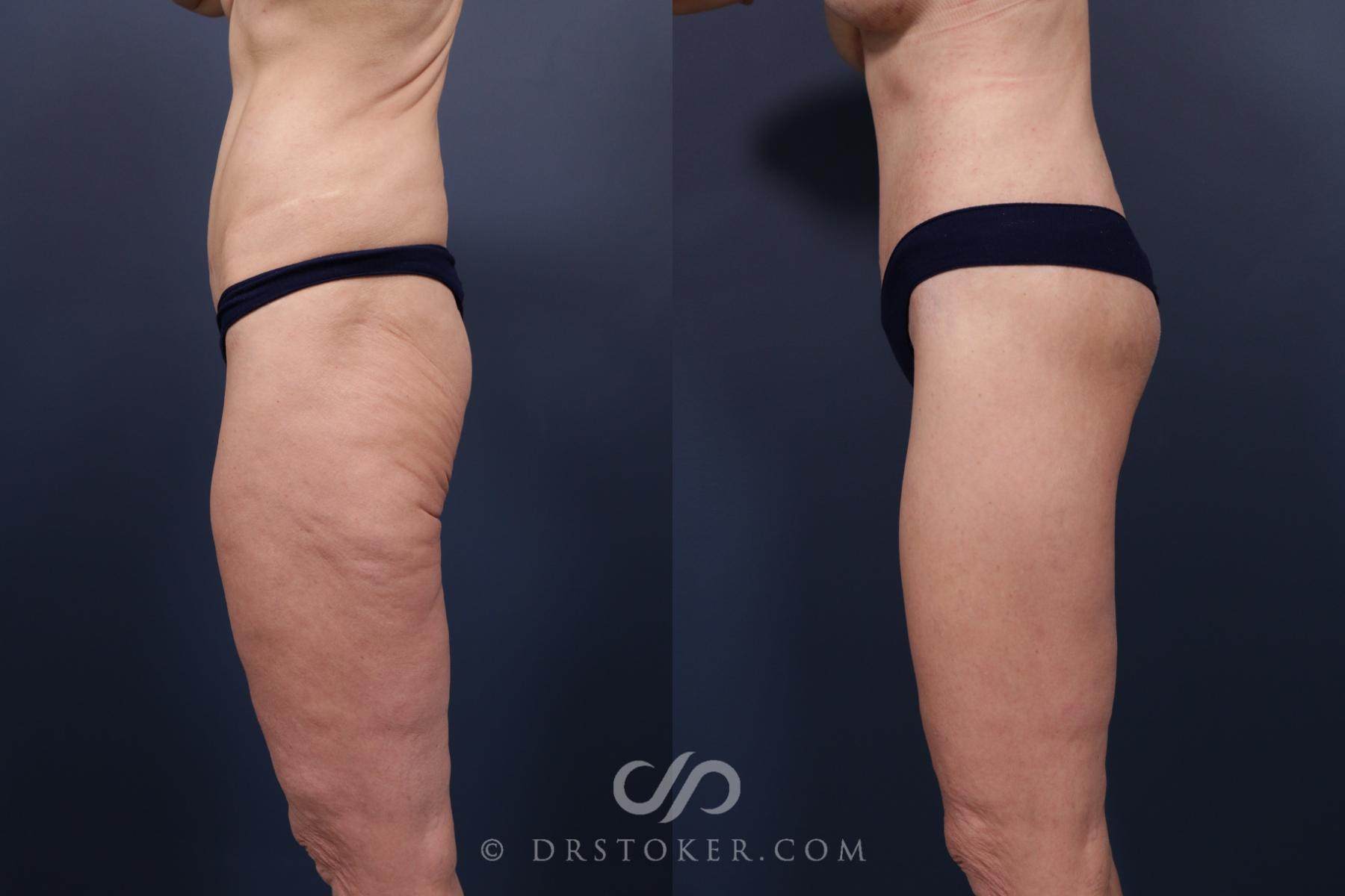 Before & After Bikini Body Lift ™ Case 2518 Left Side View in Los Angeles, CA