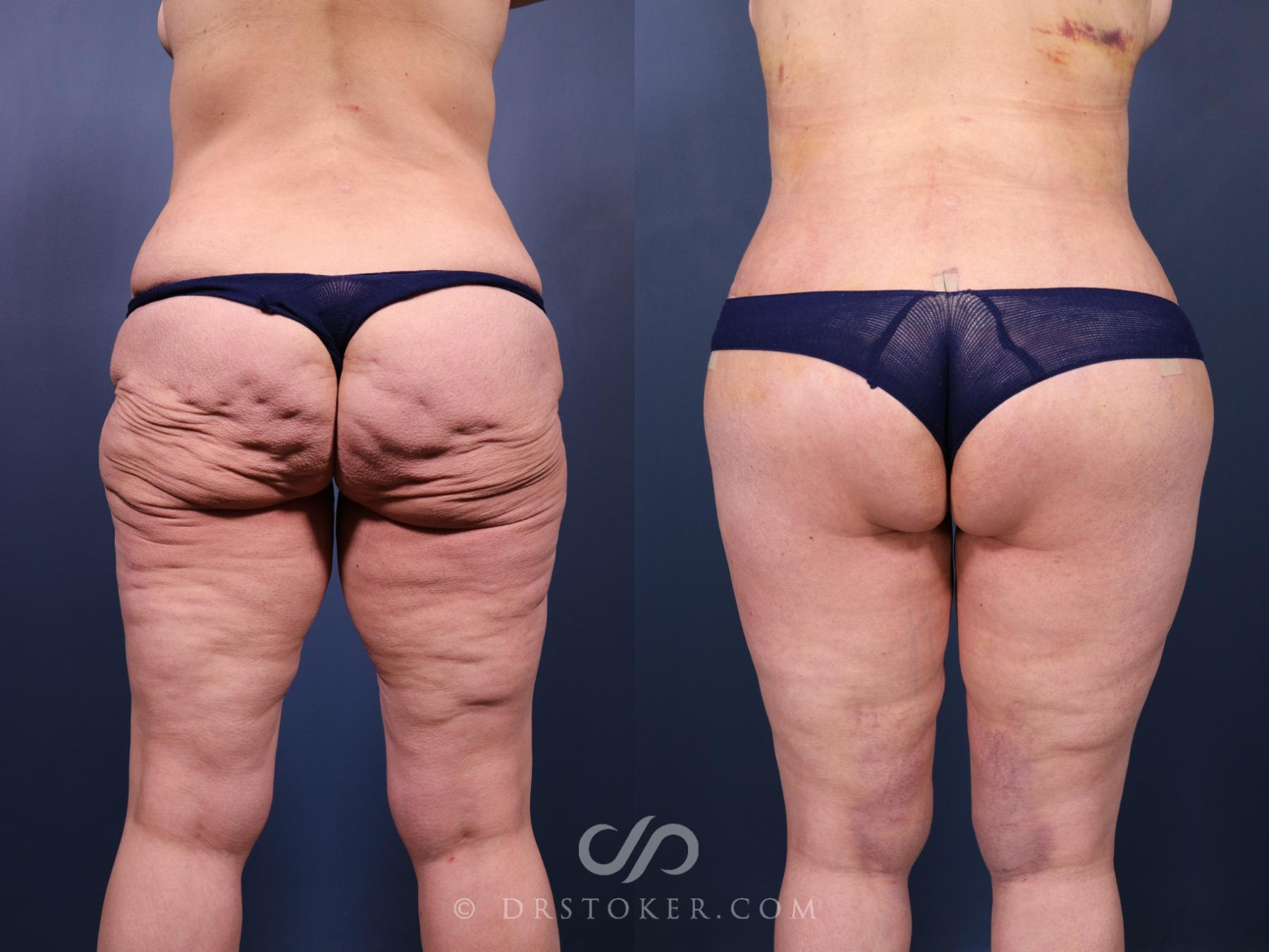 Before & After Bikini Body Lift ™ Case 2521 Back View in Los Angeles, CA