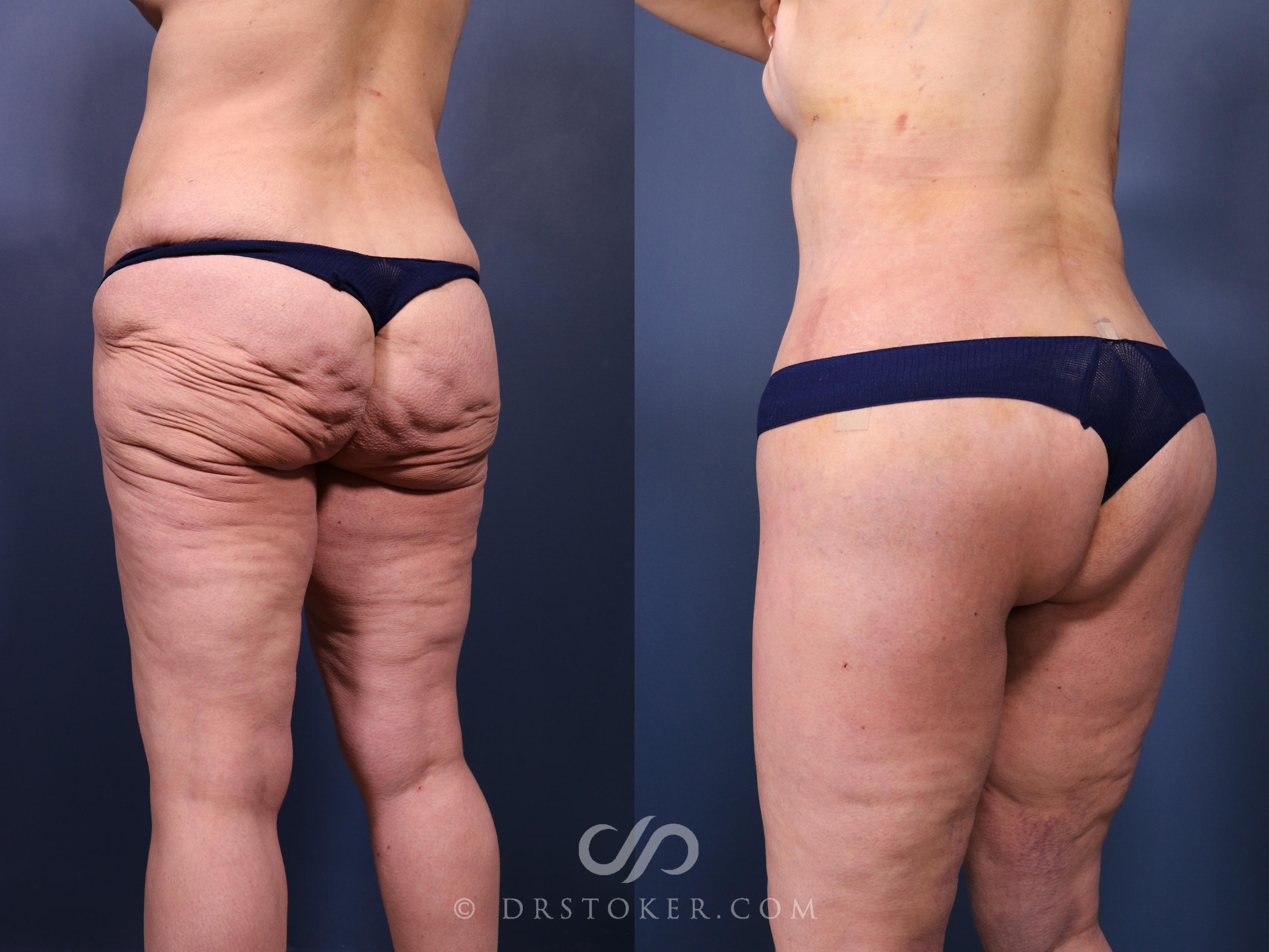 Before & After Bikini Body Lift ™ Case 2521 Left Oblique View in Los Angeles, CA