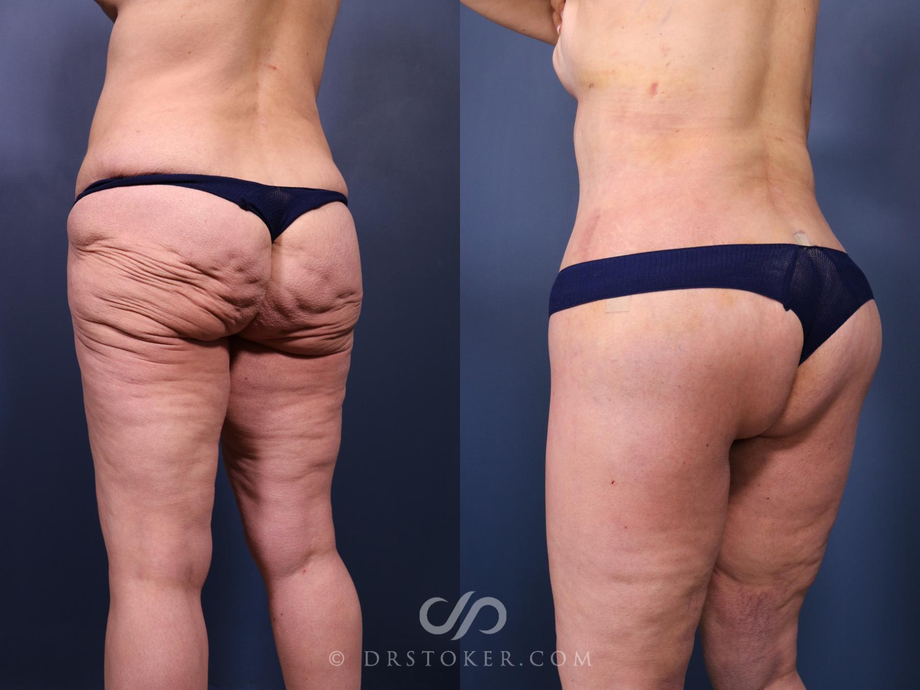Before & After Bikini Body Lift ™ Case 2521 Left Oblique View in Los Angeles, CA