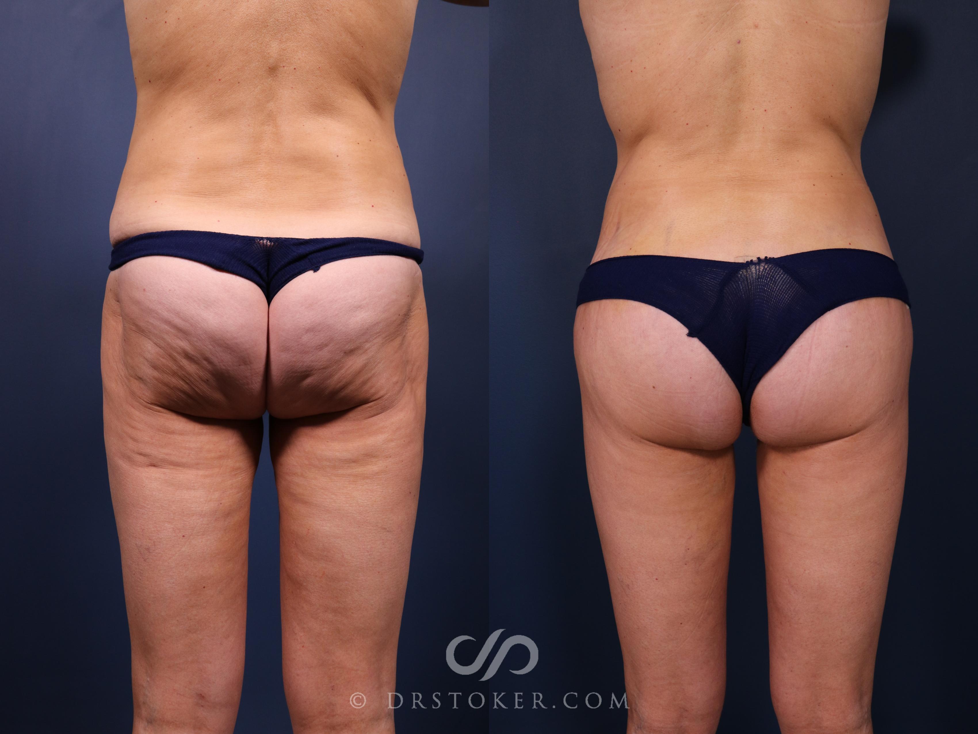 Before & After Bikini Body Lift ™ Case 2522 Back View in Los Angeles, CA