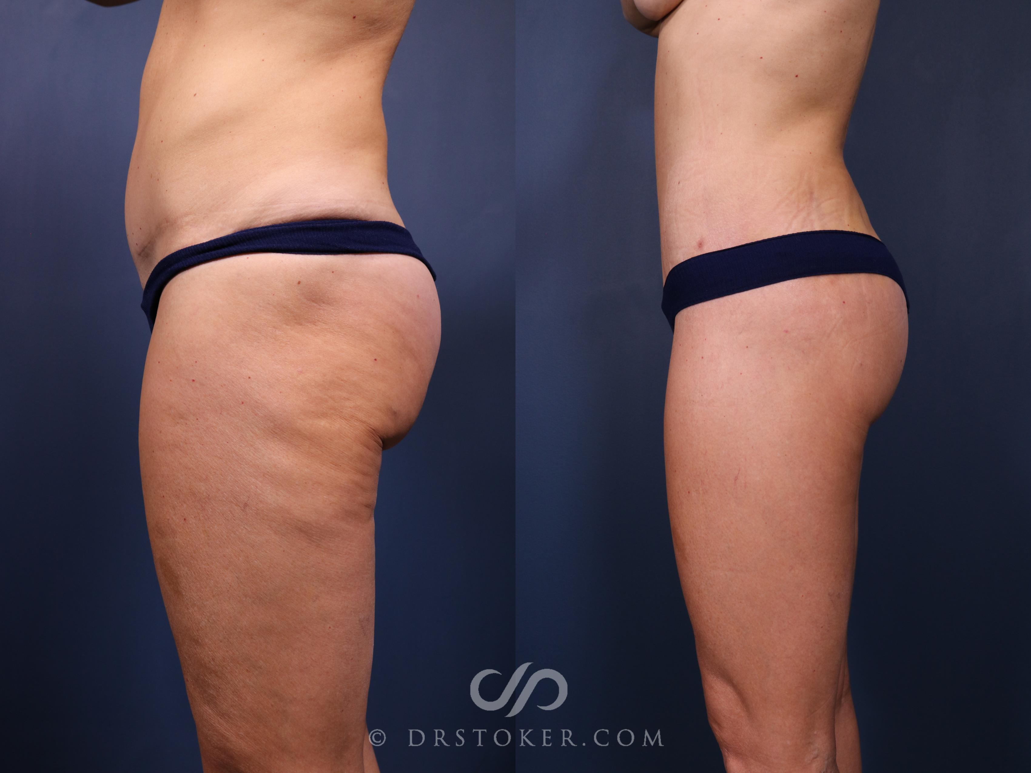 Before & After Bikini Body Lift ™ Case 2522 Left Side View in Los Angeles, CA