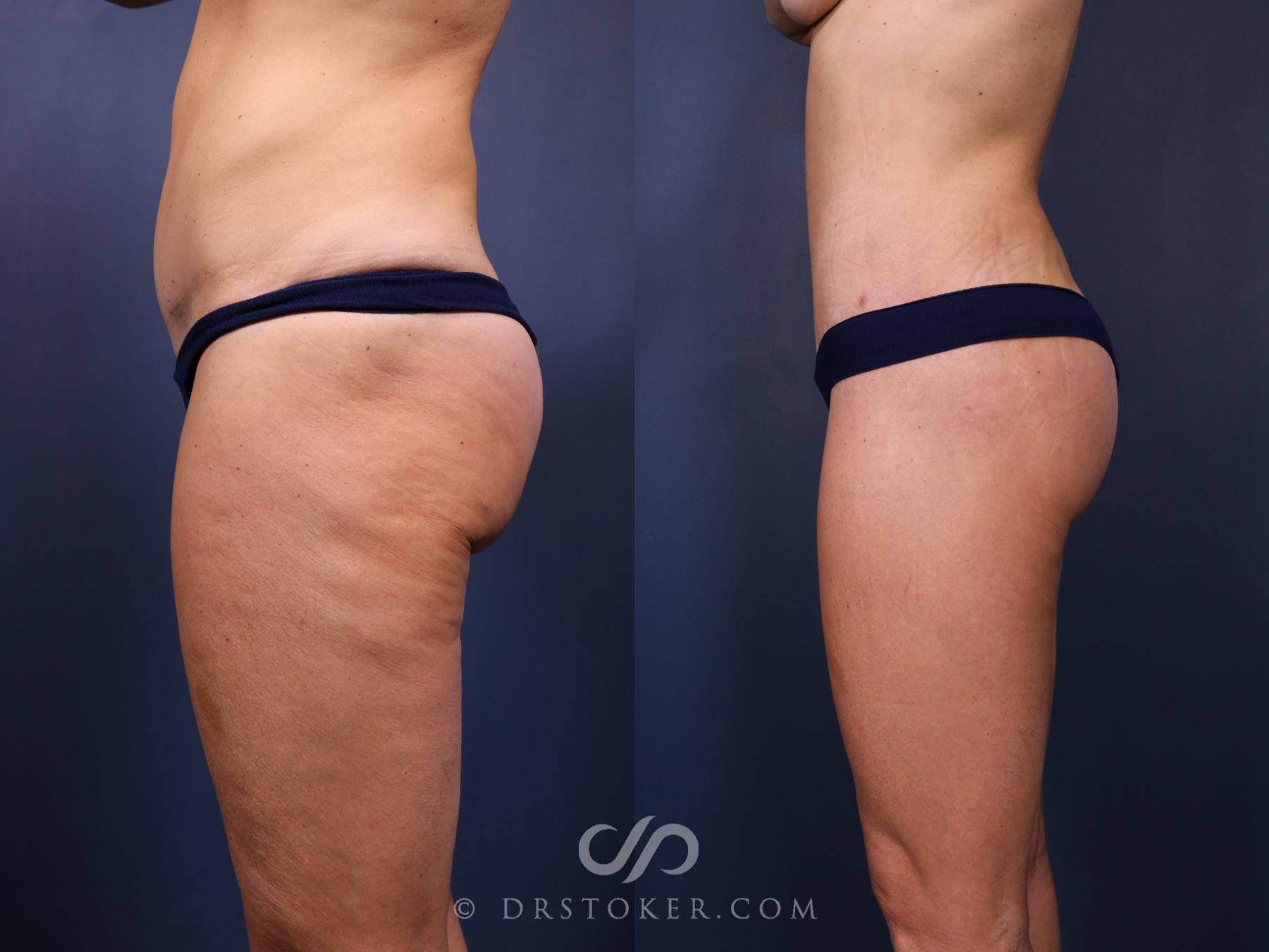 Before & After Bikini Body Lift ™ Case 2522 Left Side View in Los Angeles, CA
