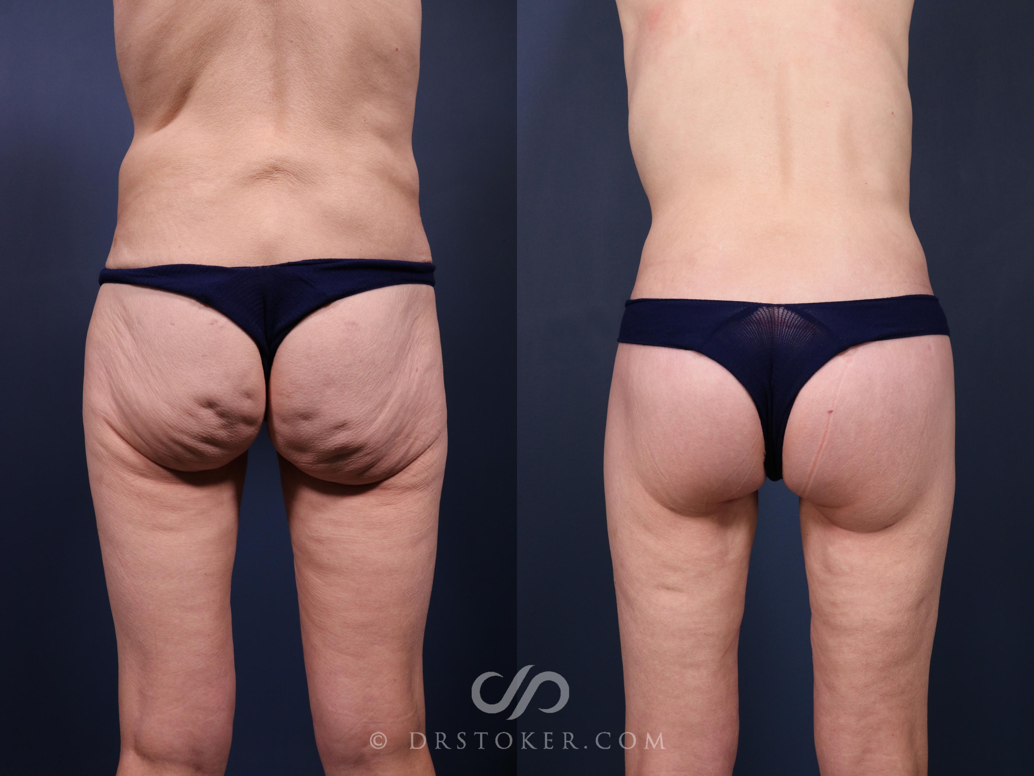 Before & After Bikini Body Lift ™ Case 2523 Back View in Los Angeles, CA