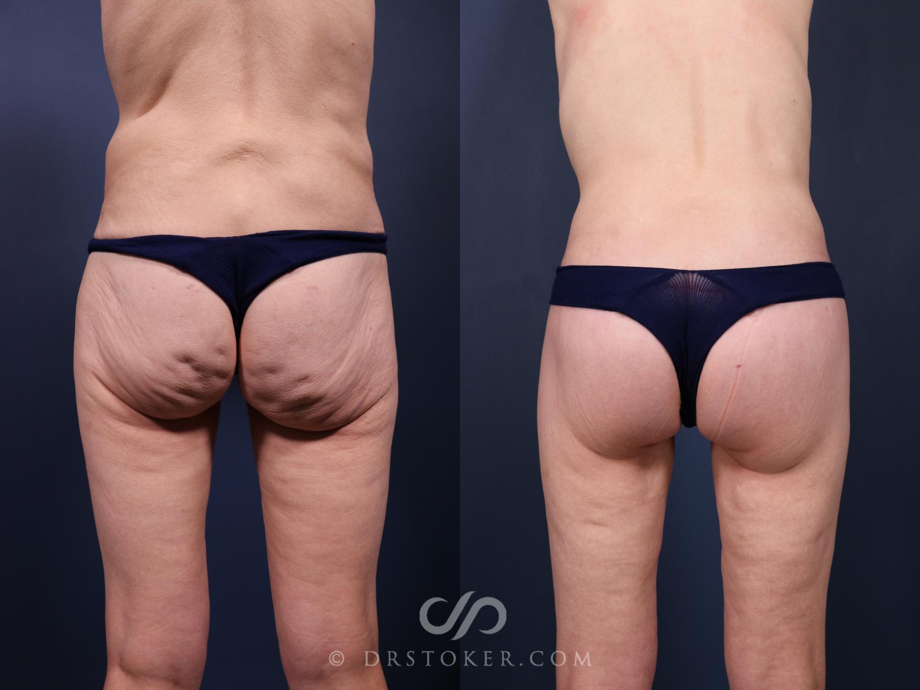 Before & After Bikini Body Lift ™ Case 2523 Back View in Los Angeles, CA