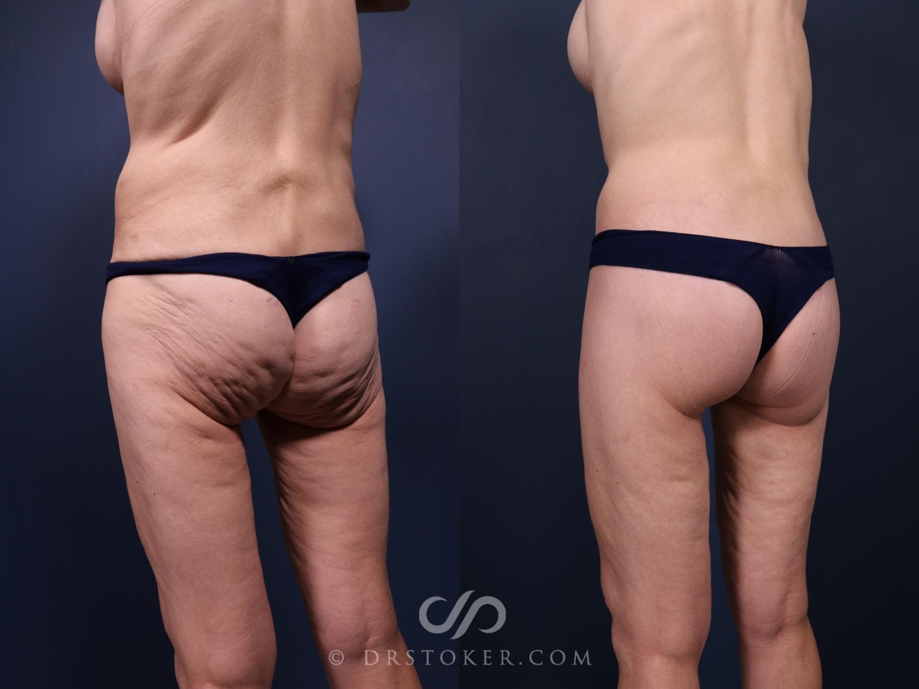 Before & After Bikini Body Lift ™ Case 2523 Left Oblique View in Los Angeles, CA