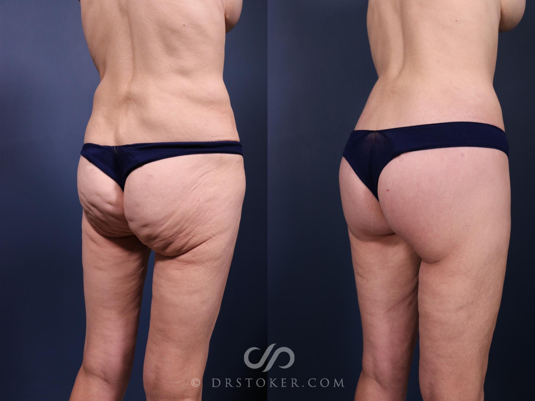 Before & After Bikini Body Lift ™ Case 2523 Right Oblique View in Los Angeles, CA