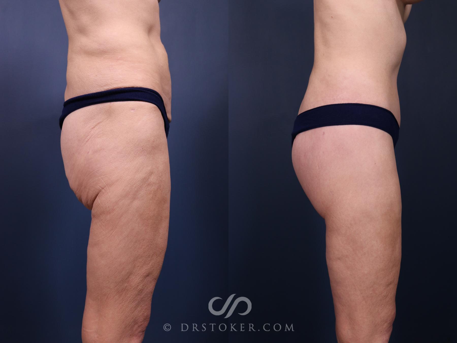 Before & After Bikini Body Lift ™ Case 2523 Right Side View in Los Angeles, CA